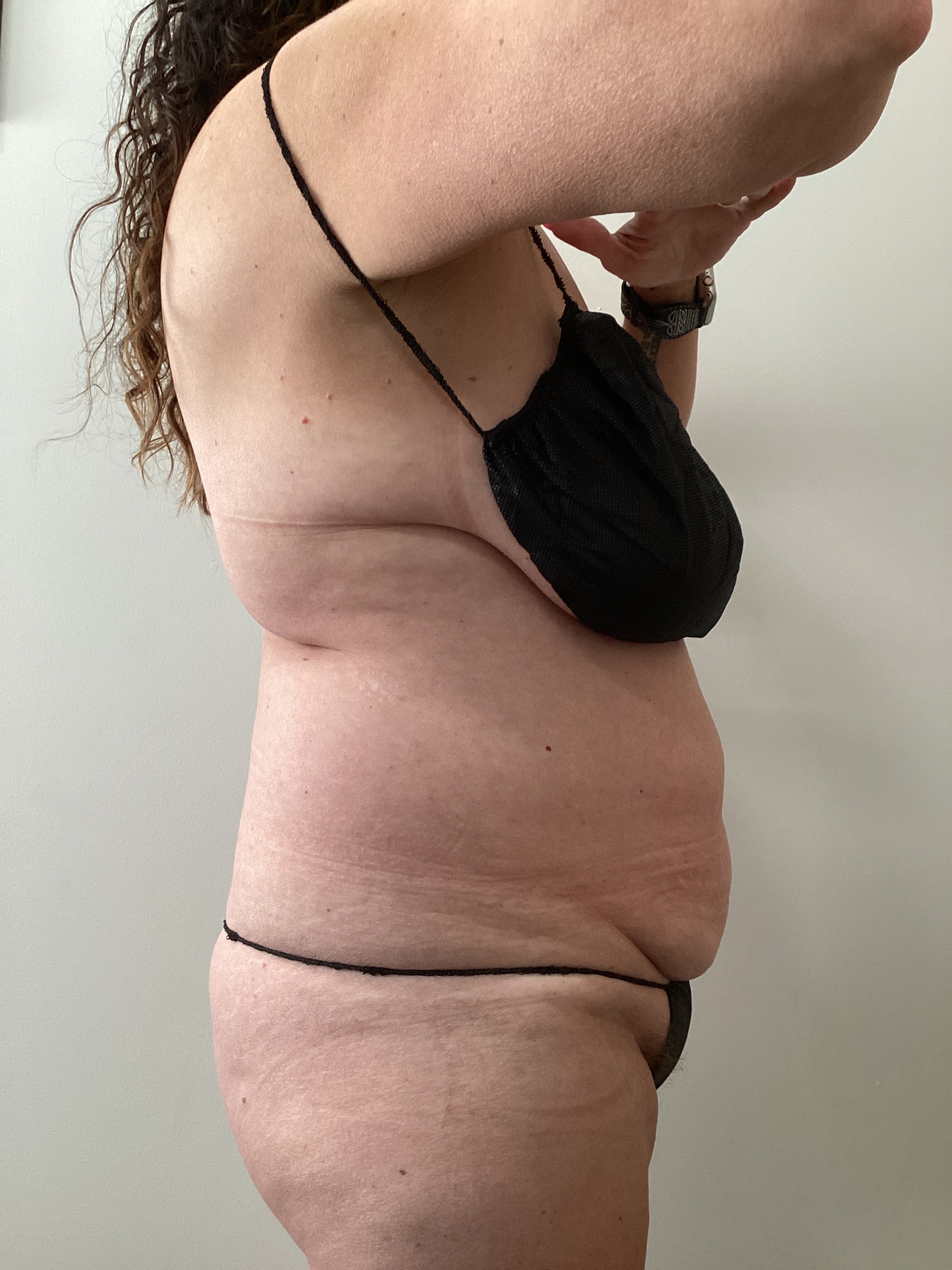 1 - Body treatment-before