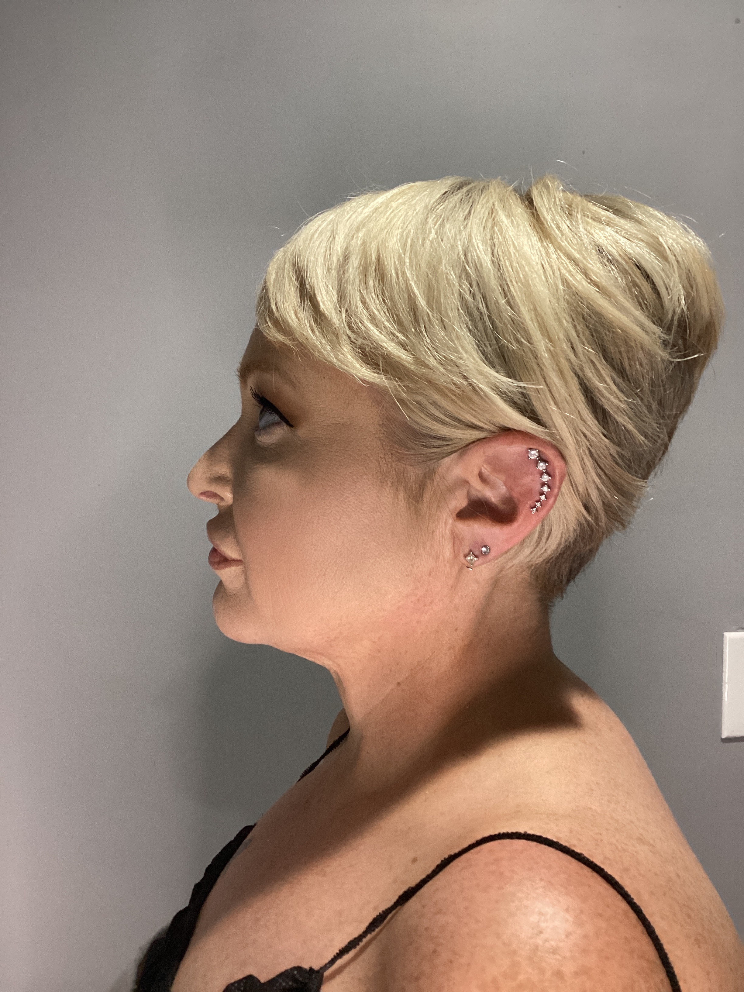 1 - Rf Neck skin tightening-after