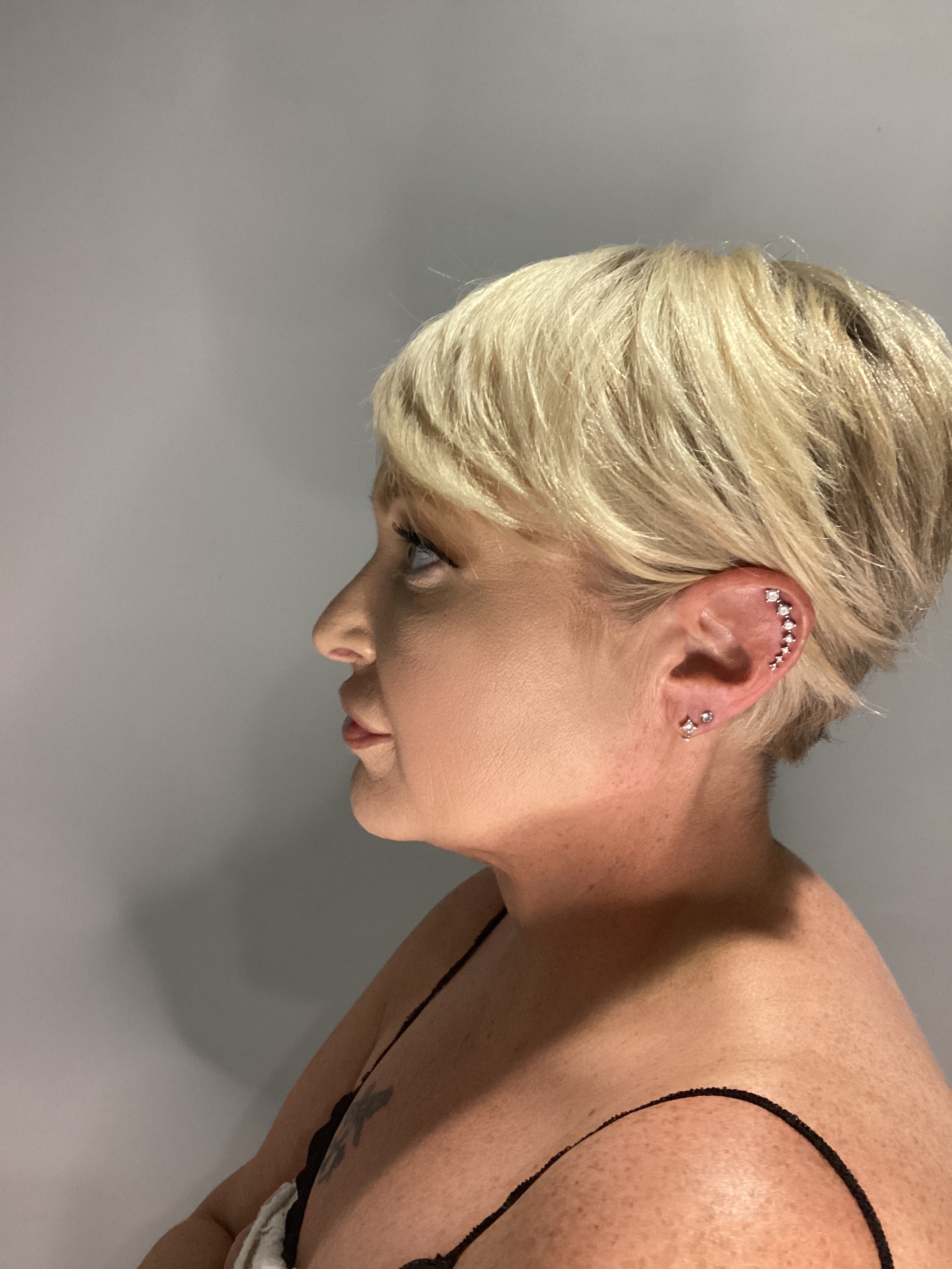 1 - Rf Neck skin tightening-before