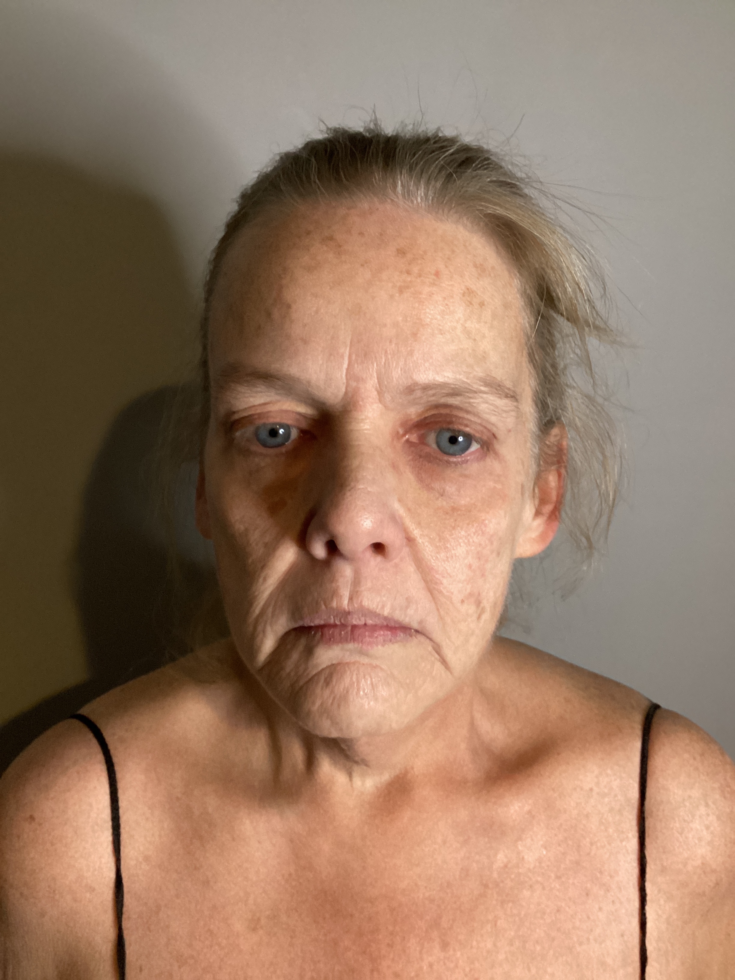 1 micro needling - 2 RF-before