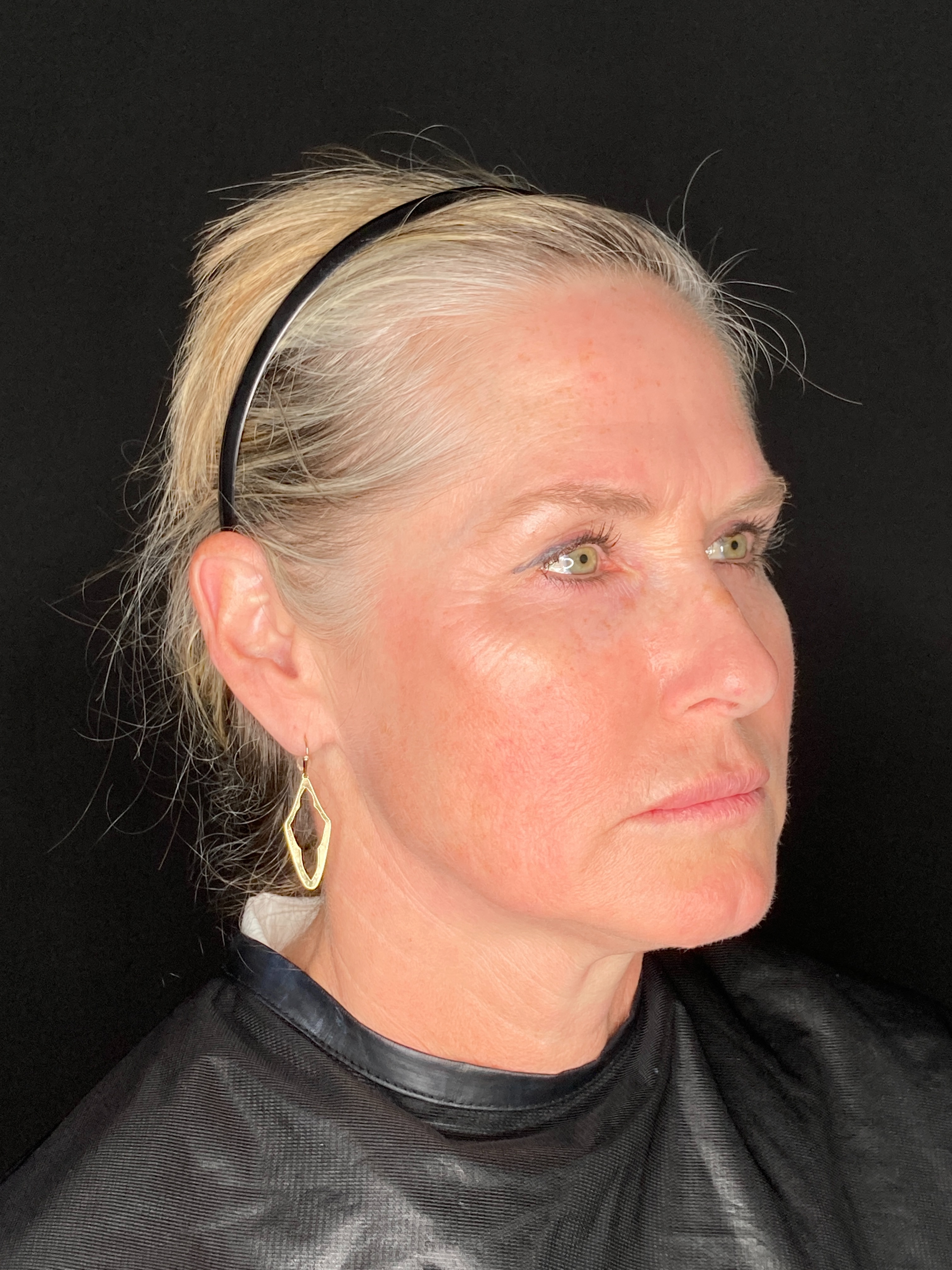 Exilis - Lower Face and Neck - Sharon McKenny LME-after