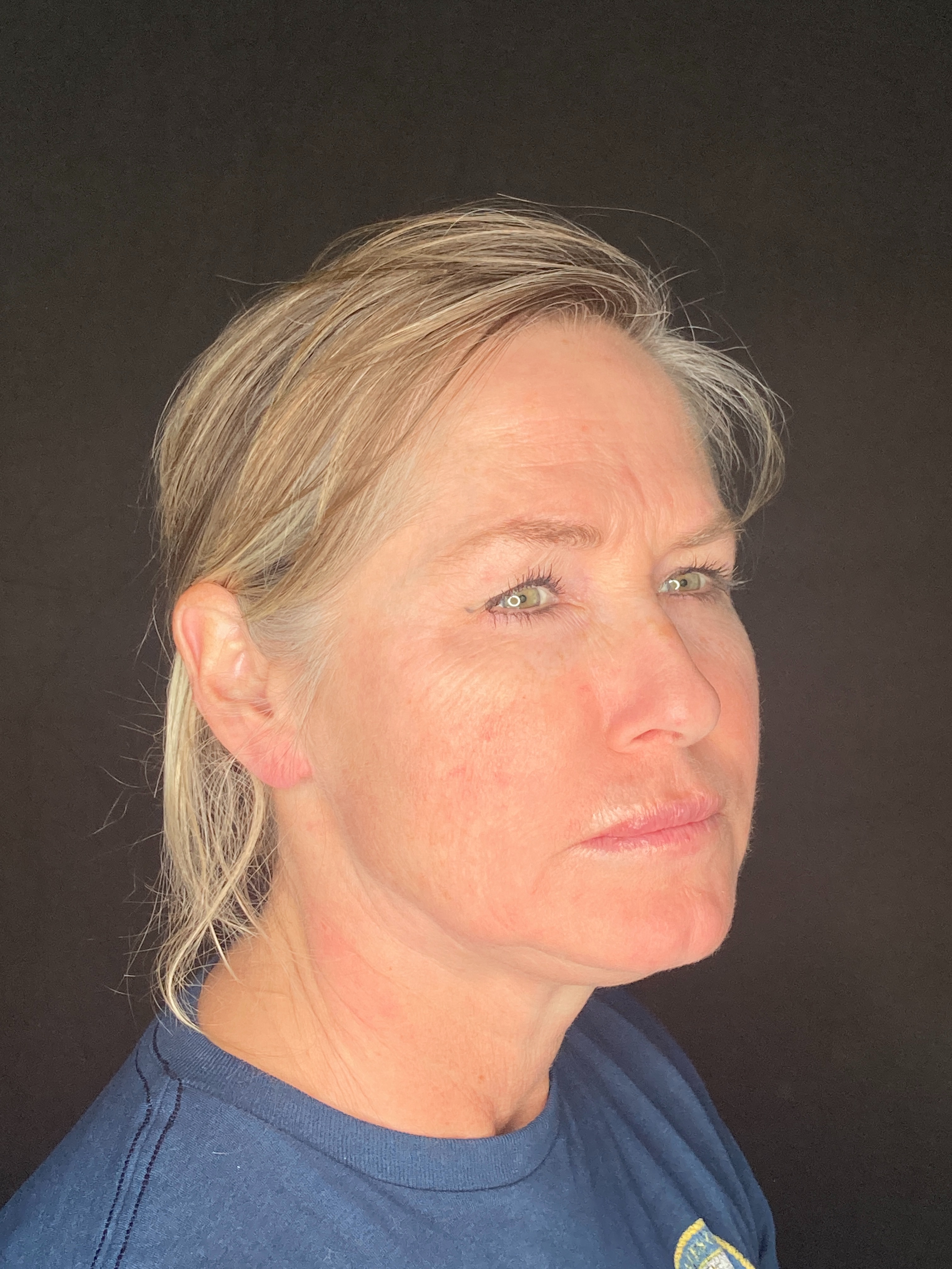 Exilis - Lower Face and Neck - Sharon McKenny LME-before