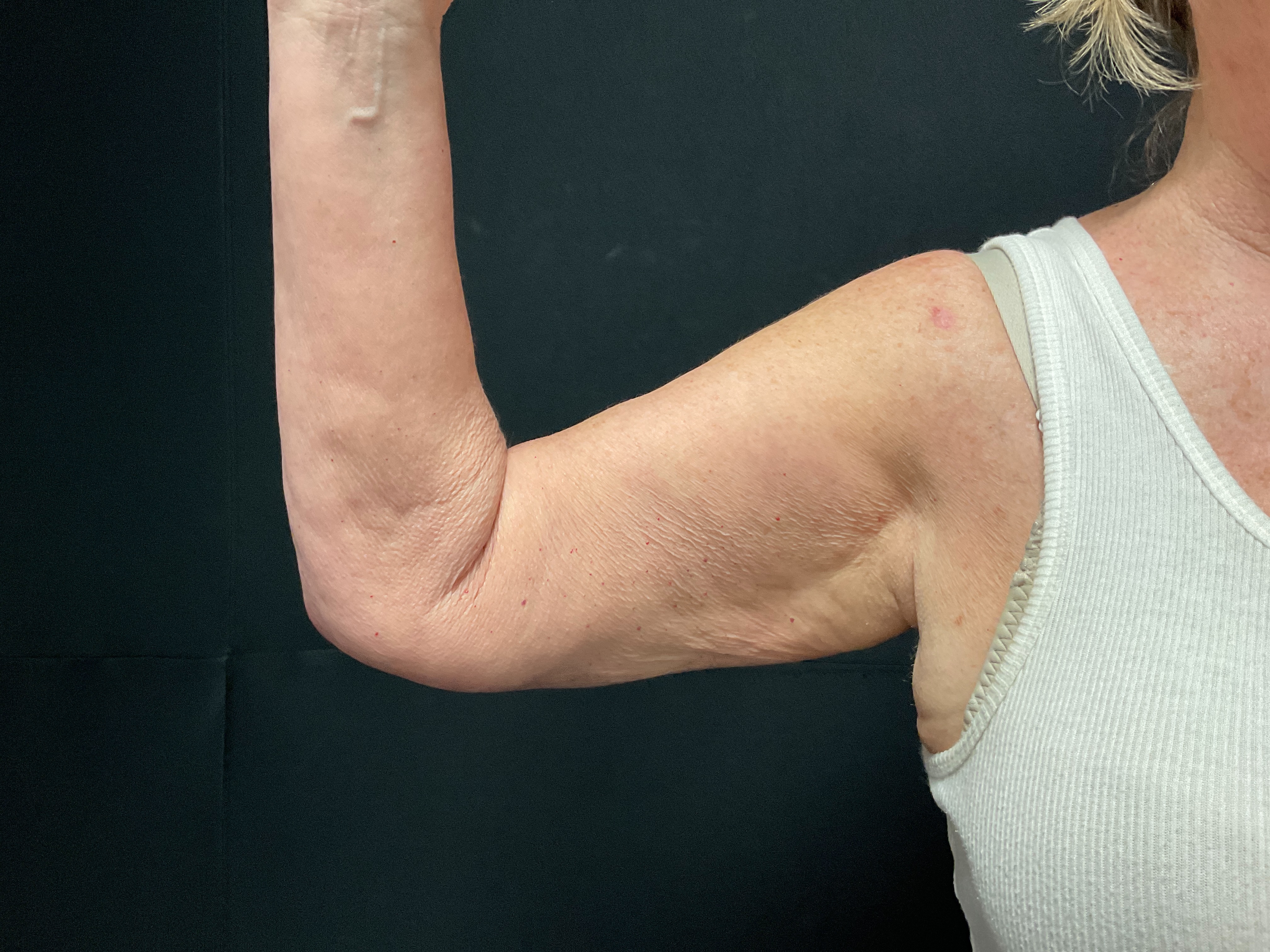 Arms post 3 sessions-after