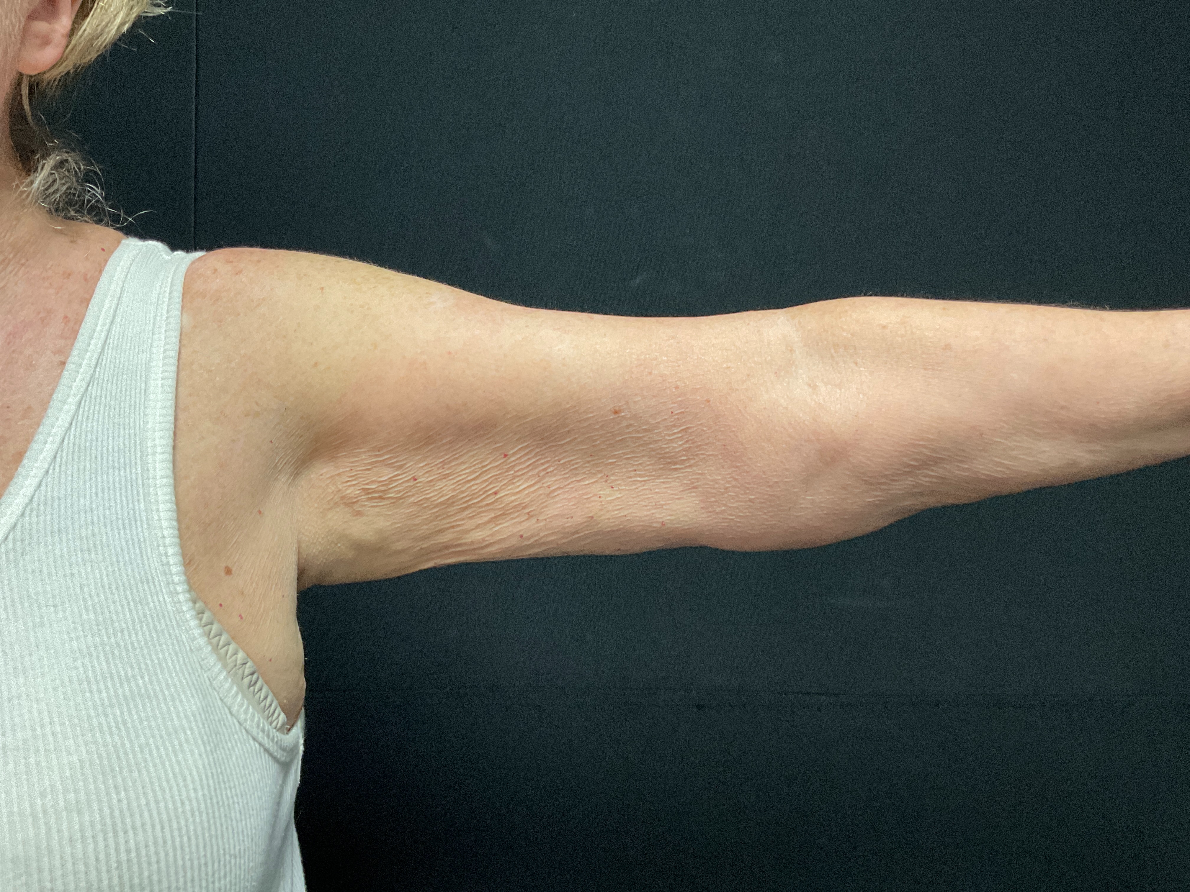 arms post 3 sessions-after