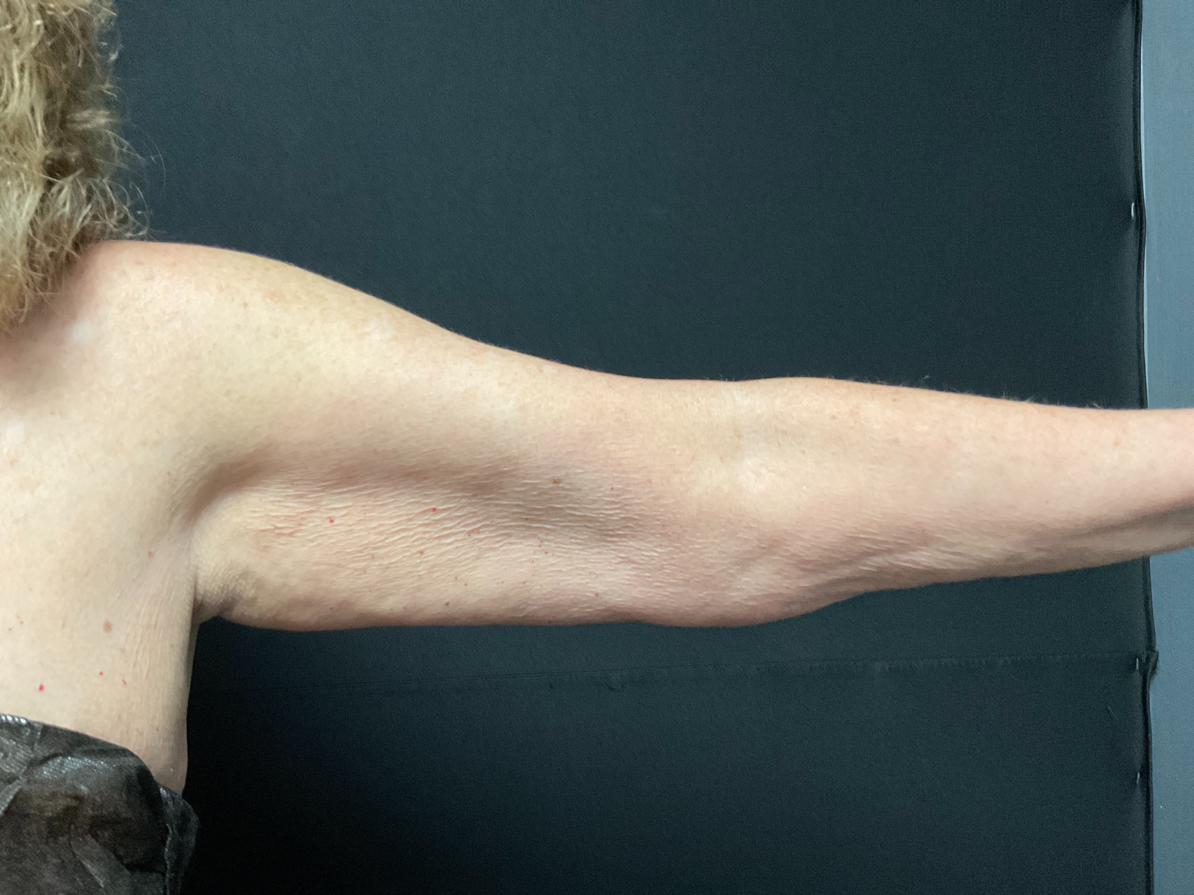 arms post 3 sessions-before