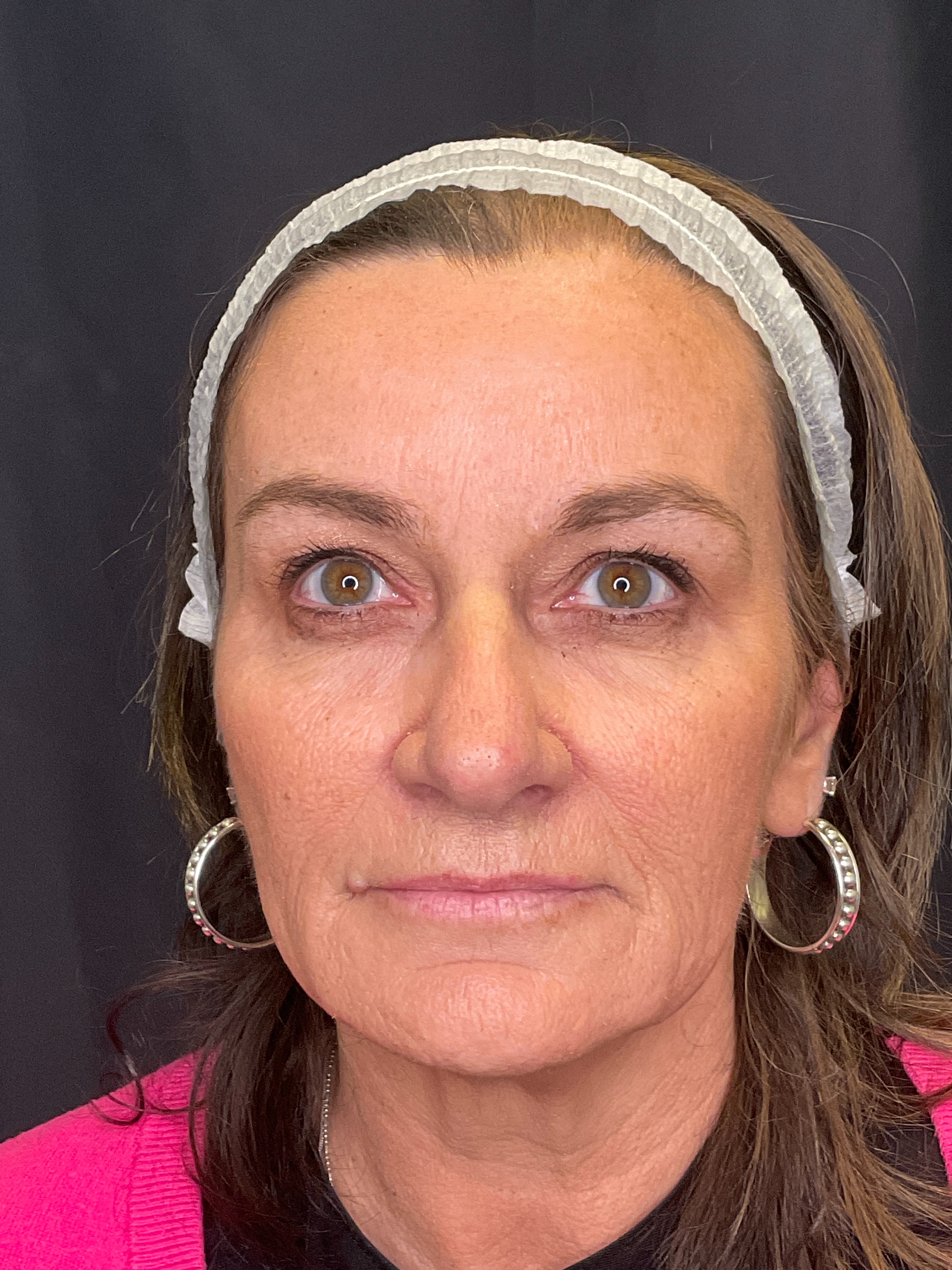 1 session with fusion tip/exosomes-after