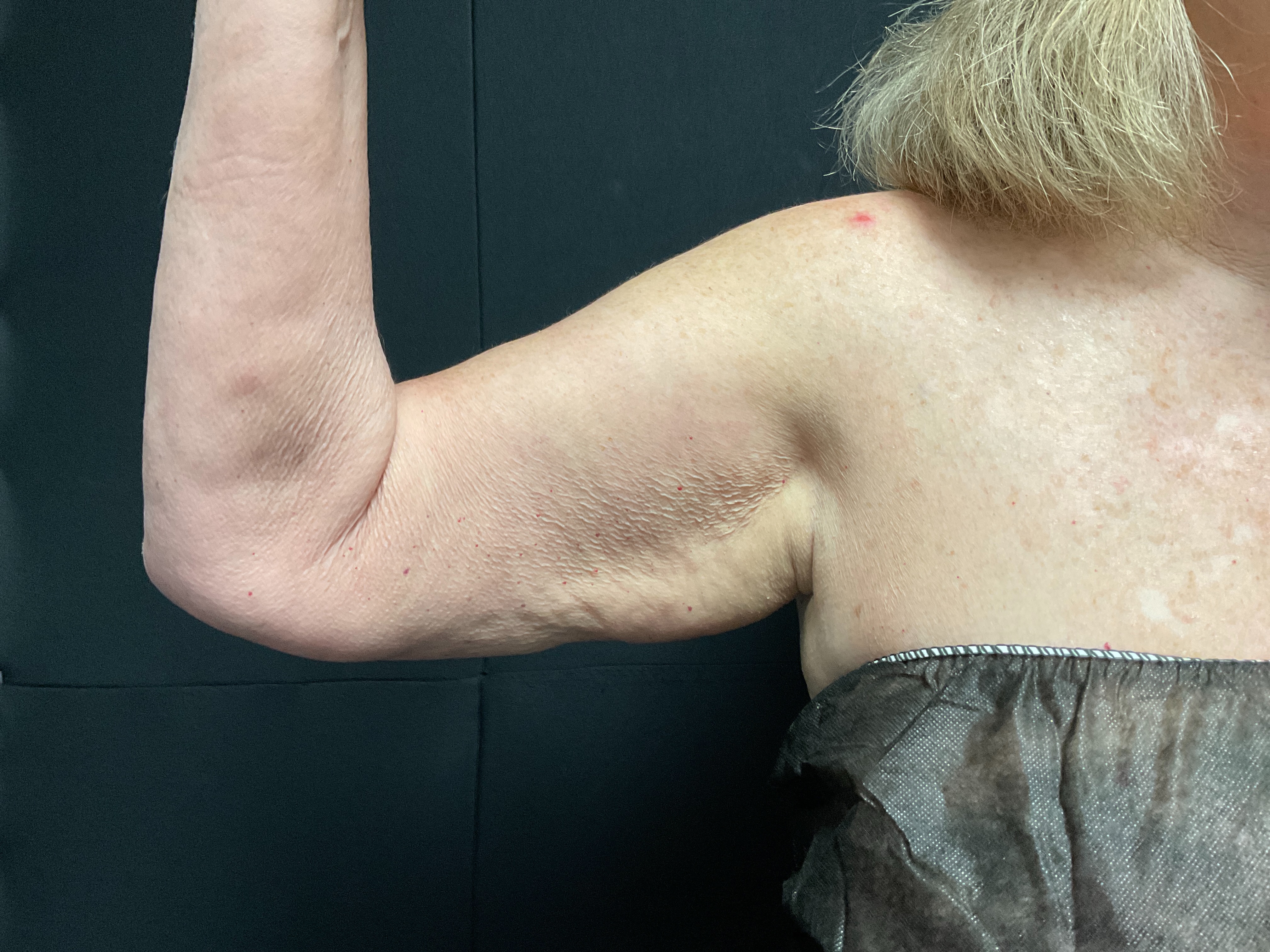 Arms post 3 sessions-before