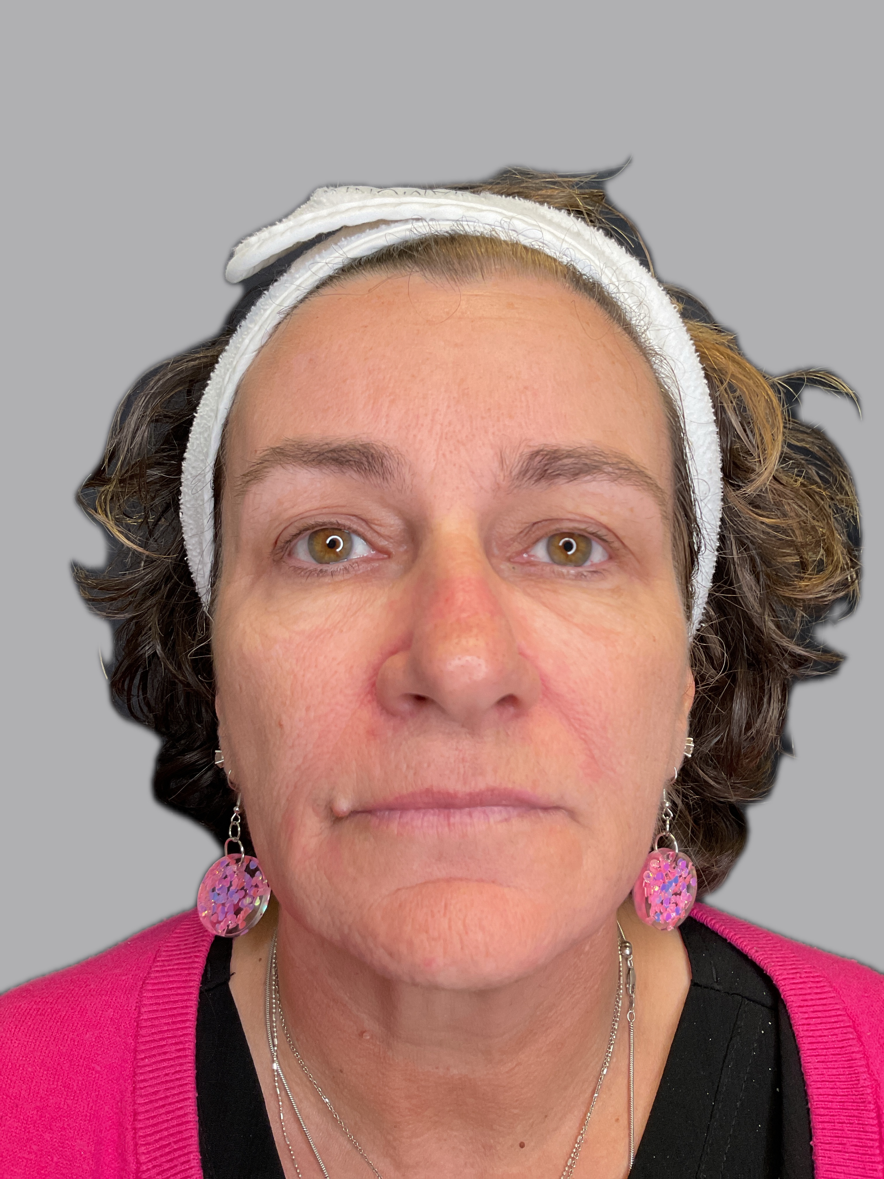 1 session with fusion tip/exosomes-before