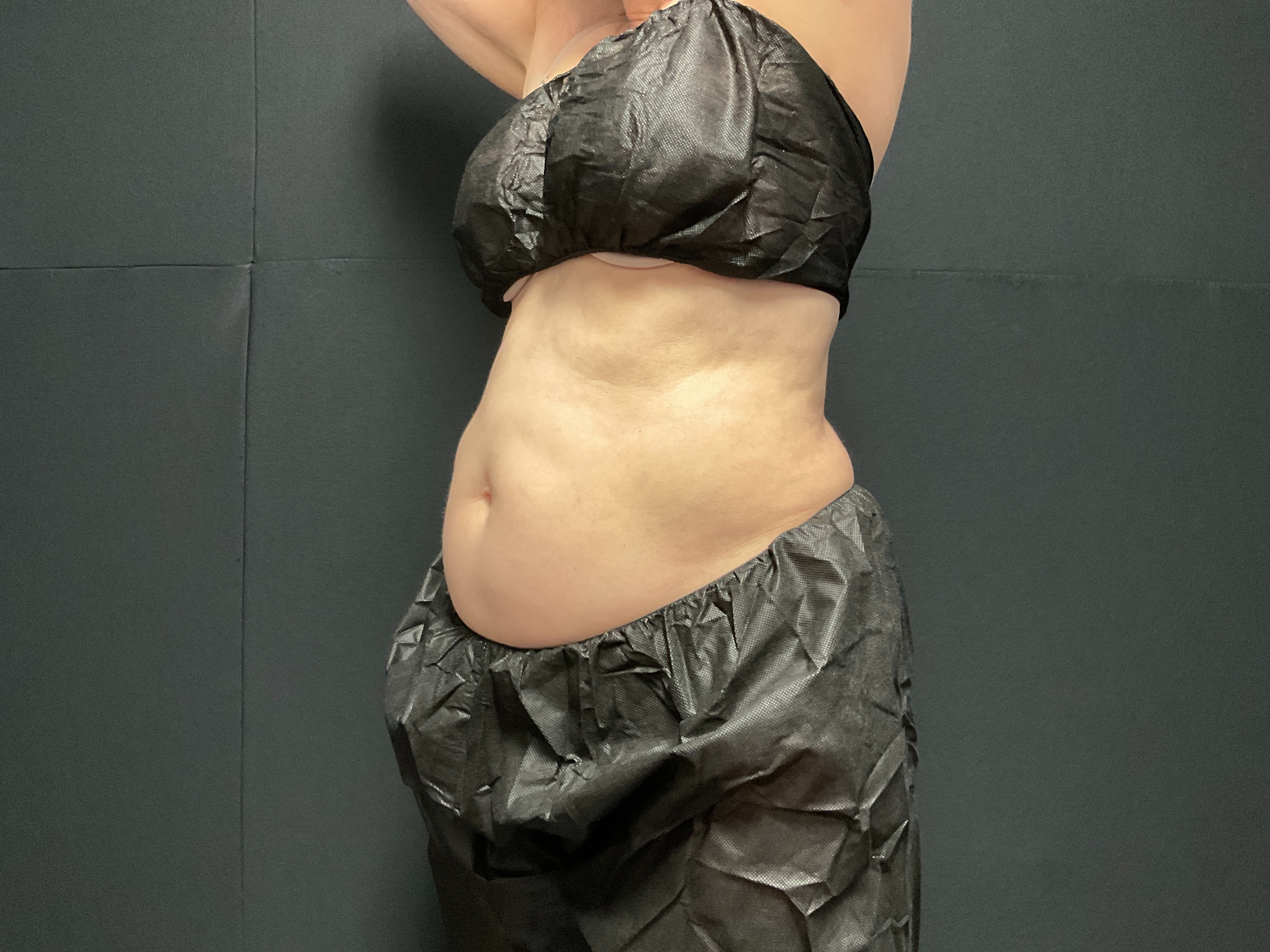 Unlimited Abdomen post 4 visits-before