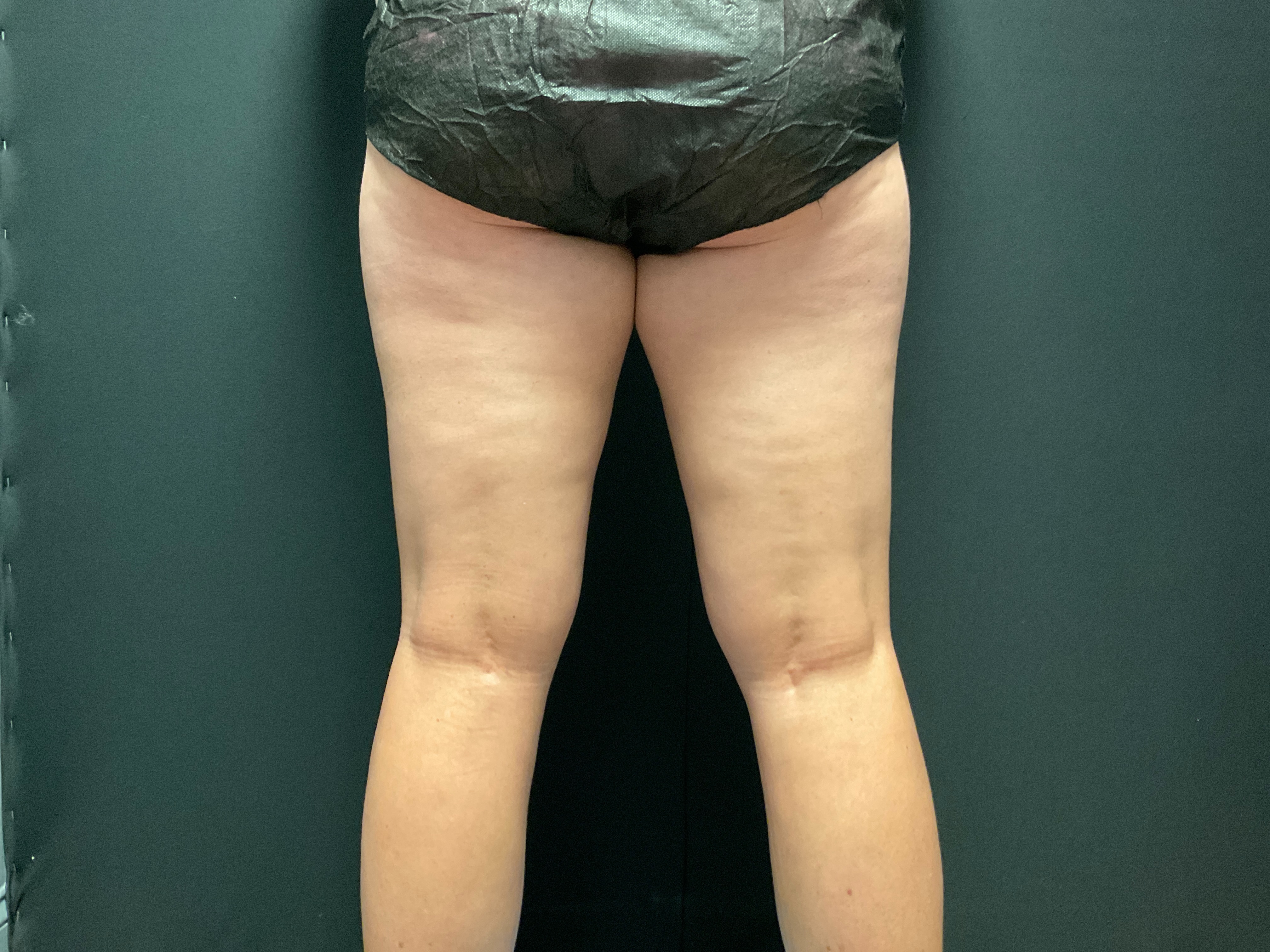 Inner thighs post 3 visits-before