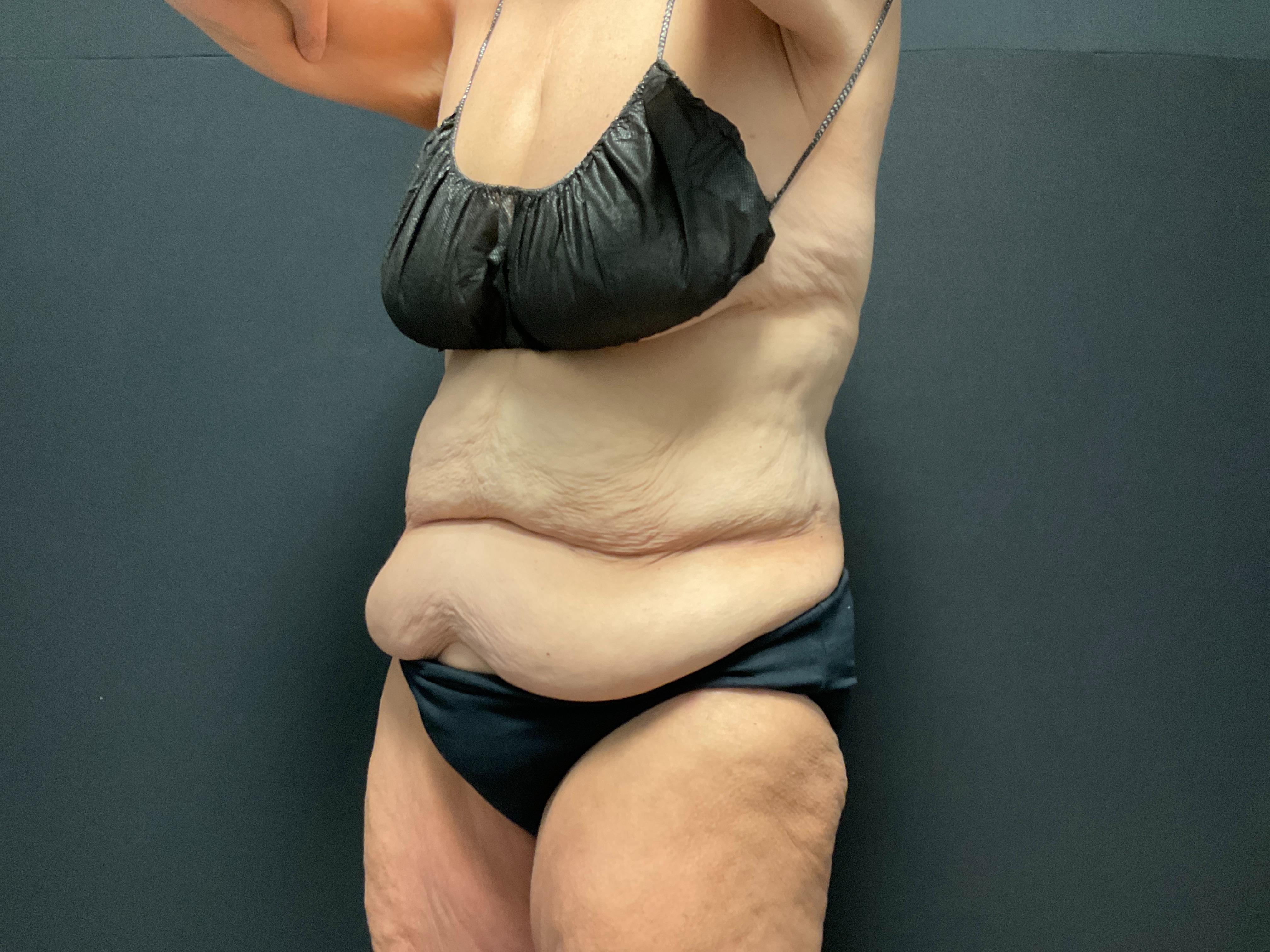 Abdomen post 4 sessions-before