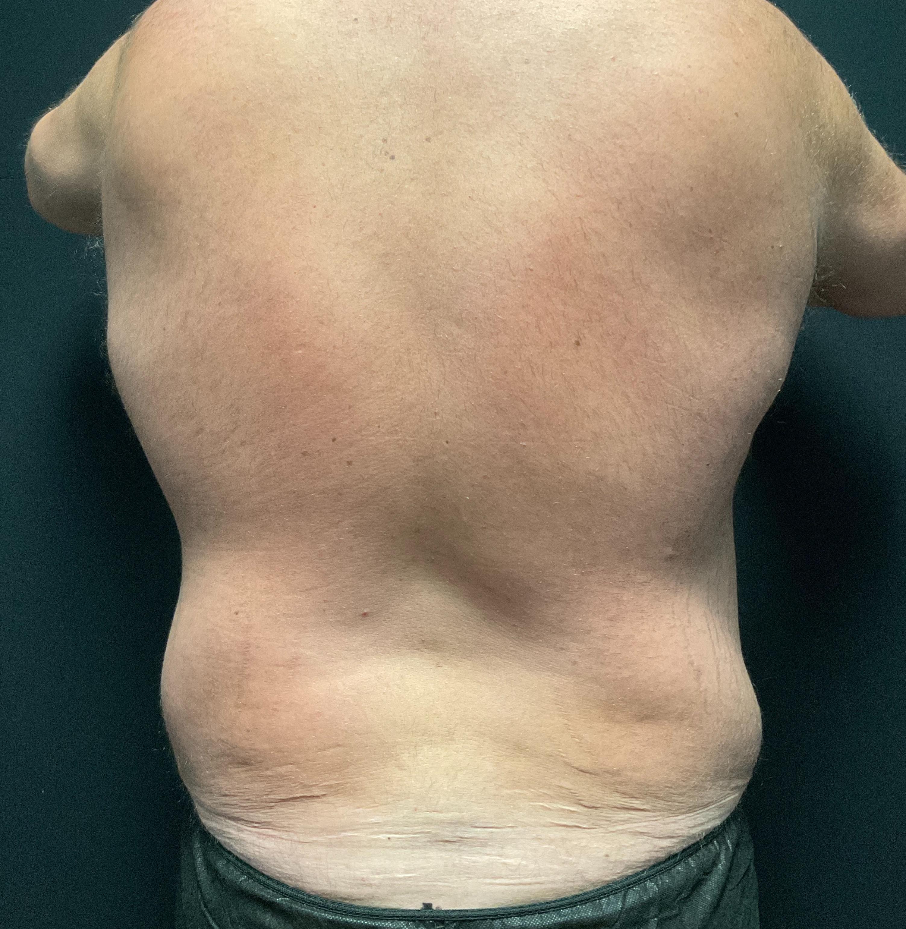 Male flanks and back post 4 visits-before