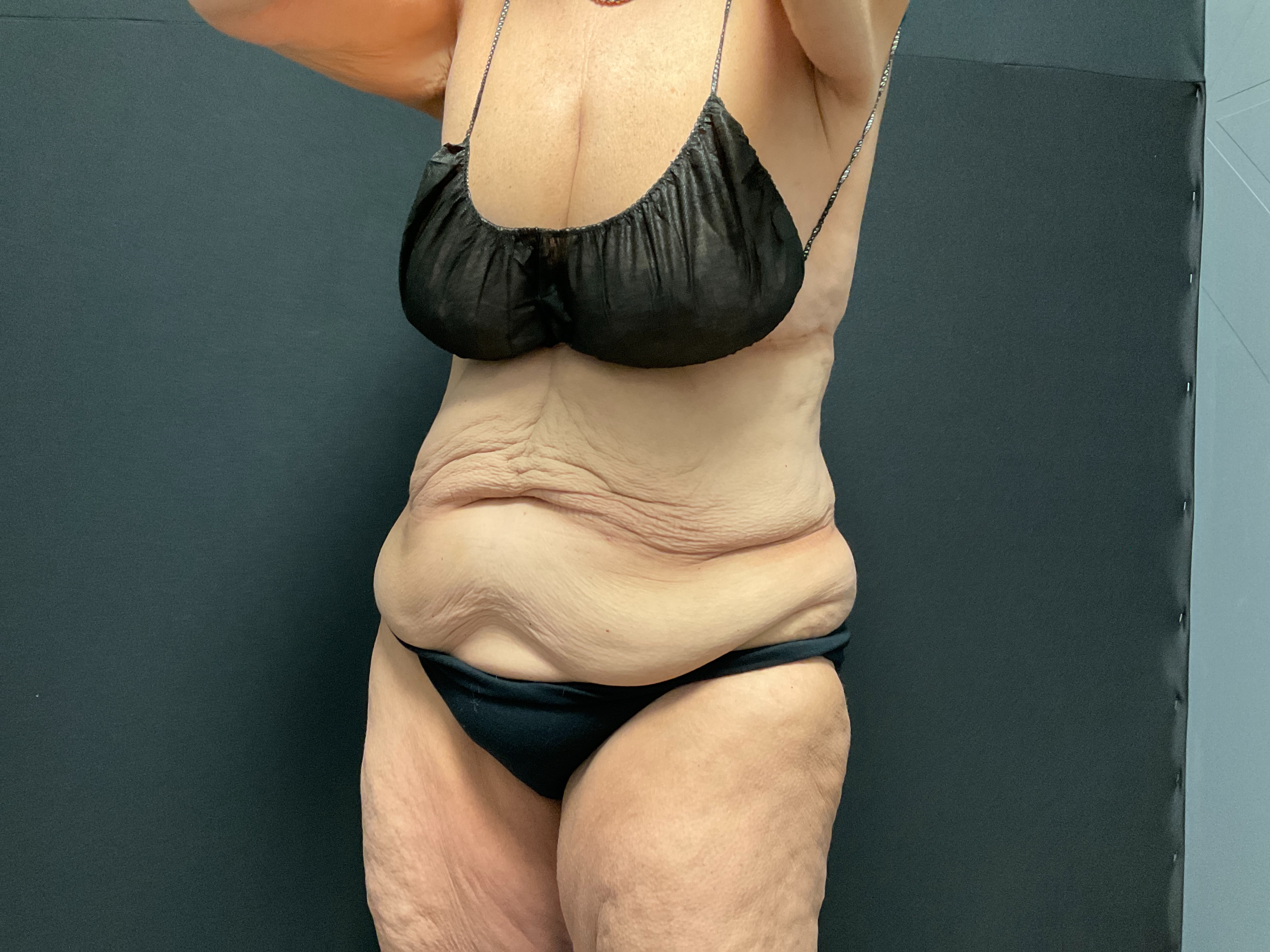 Abdomen post 4 sessions-after