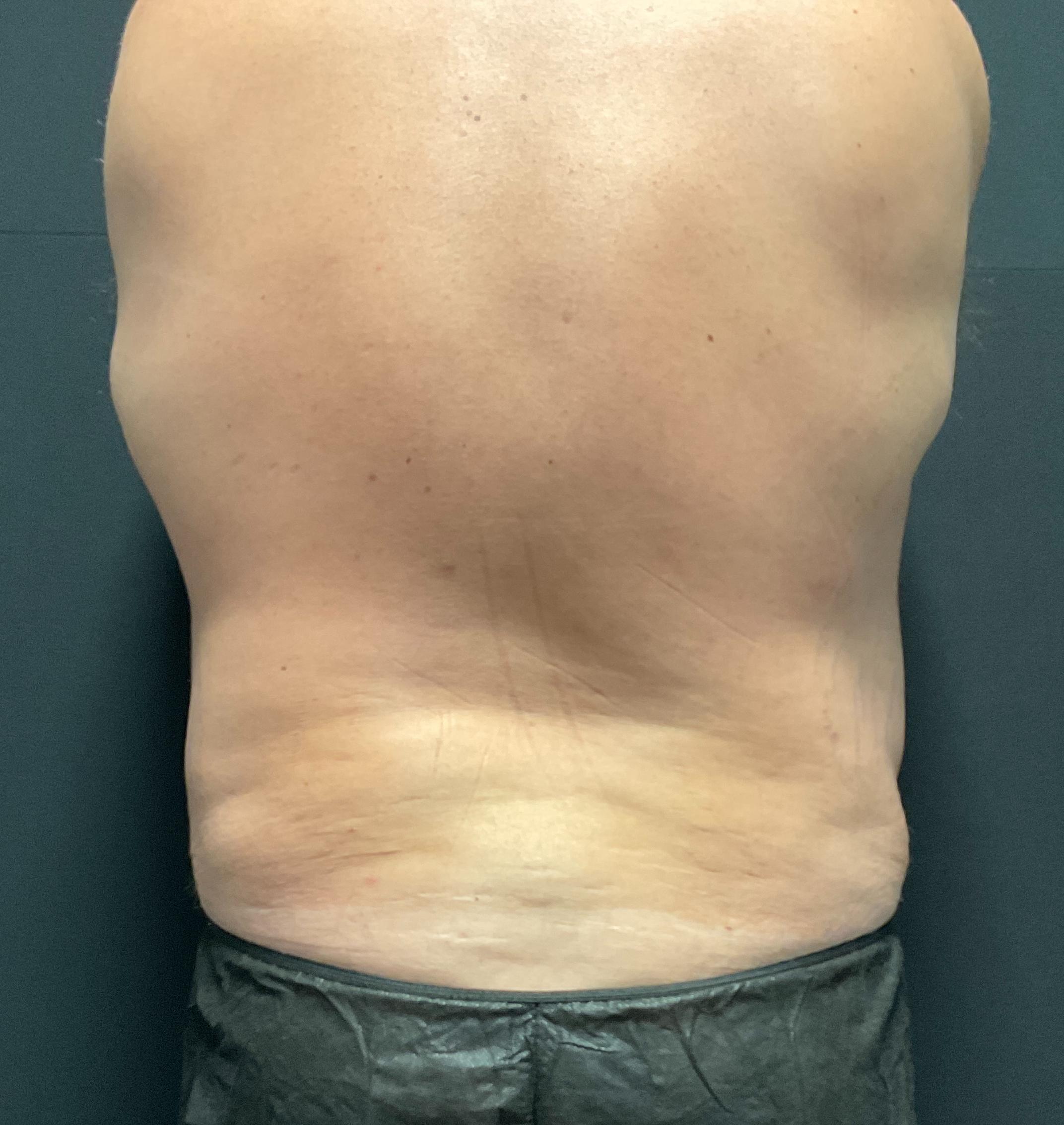 Male flanks and back post 4 visits-after