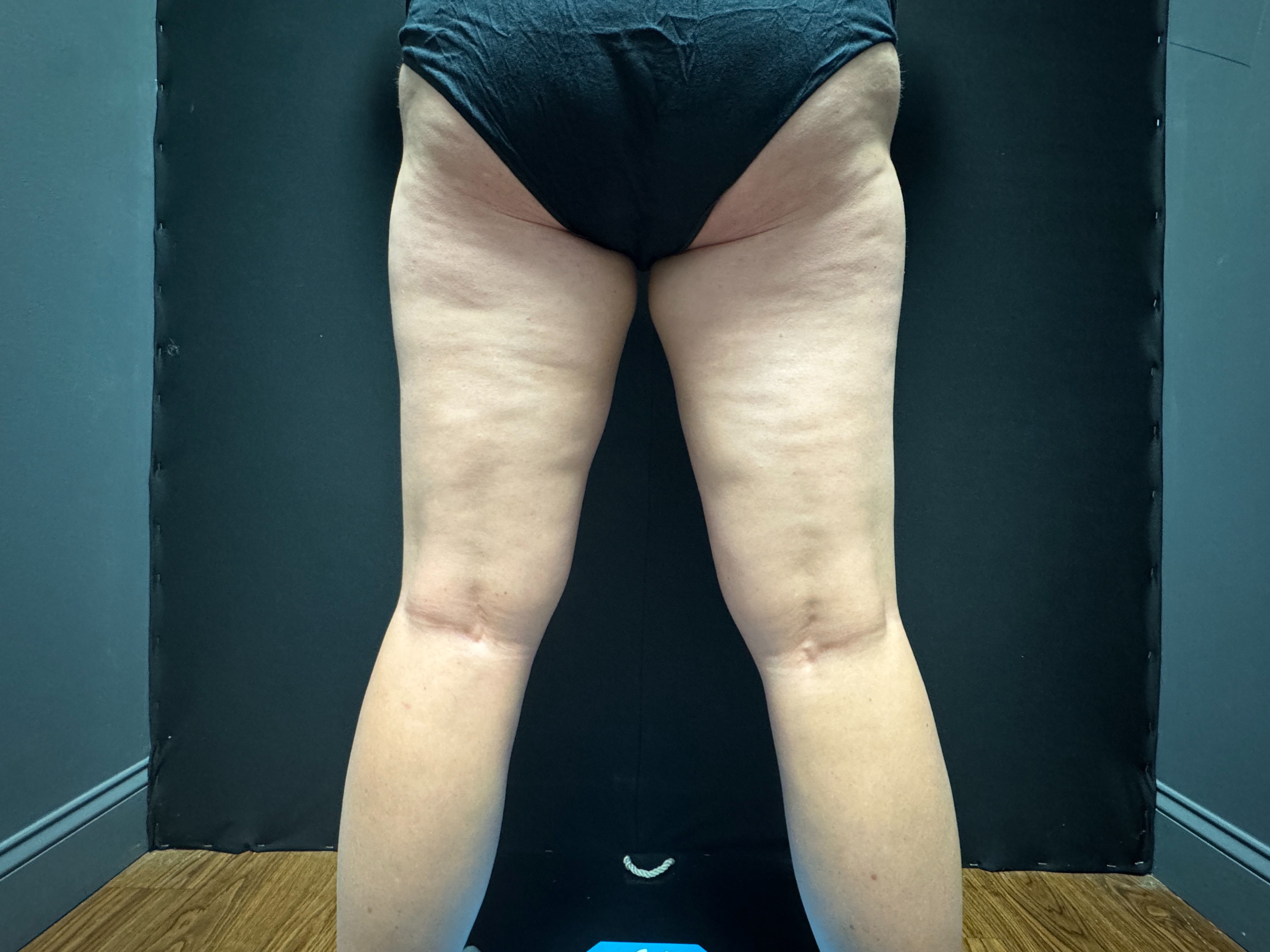 Inner thighs post 3 visits-after