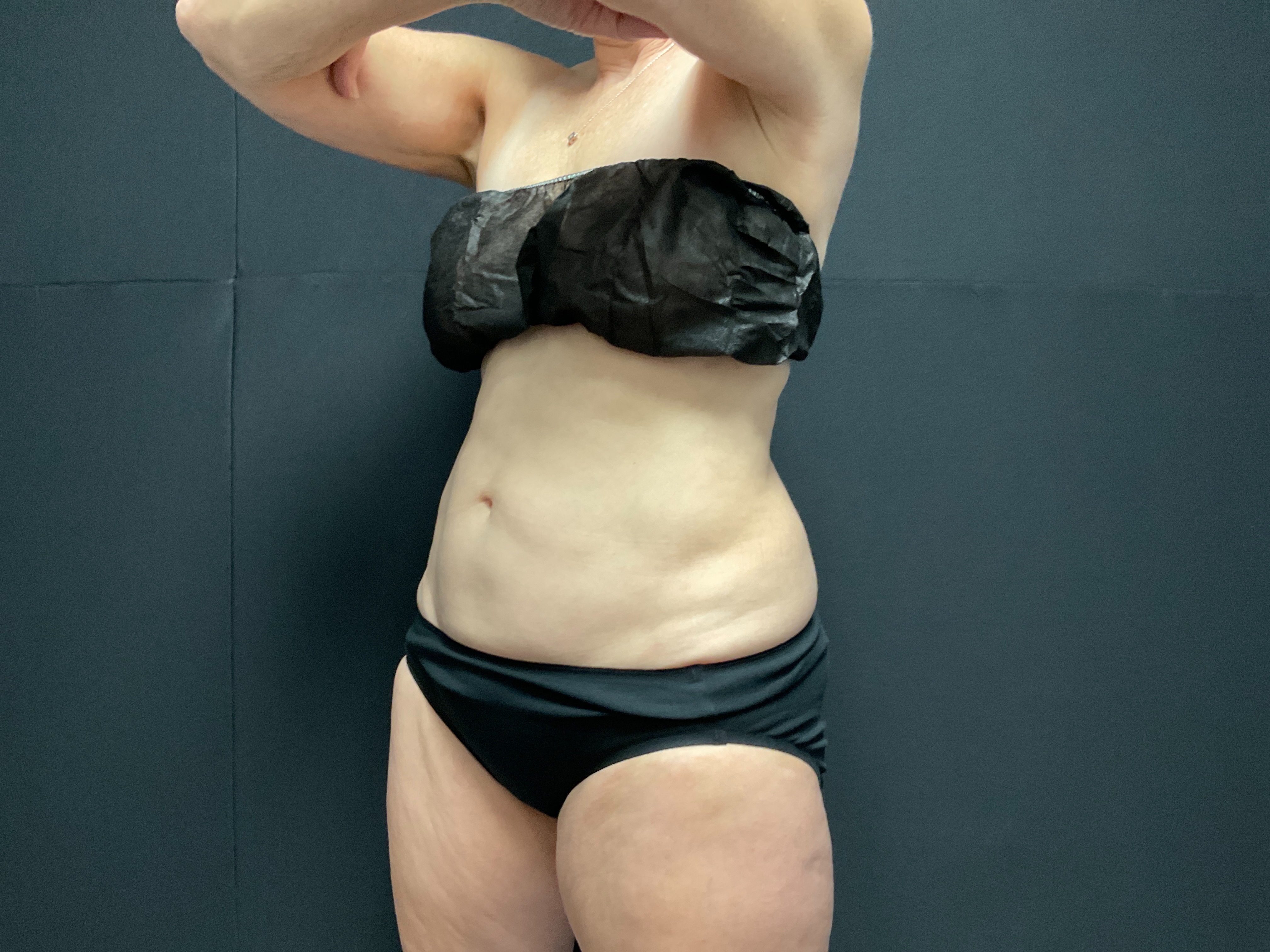 Unlimited Abdomen post 4 visits-after