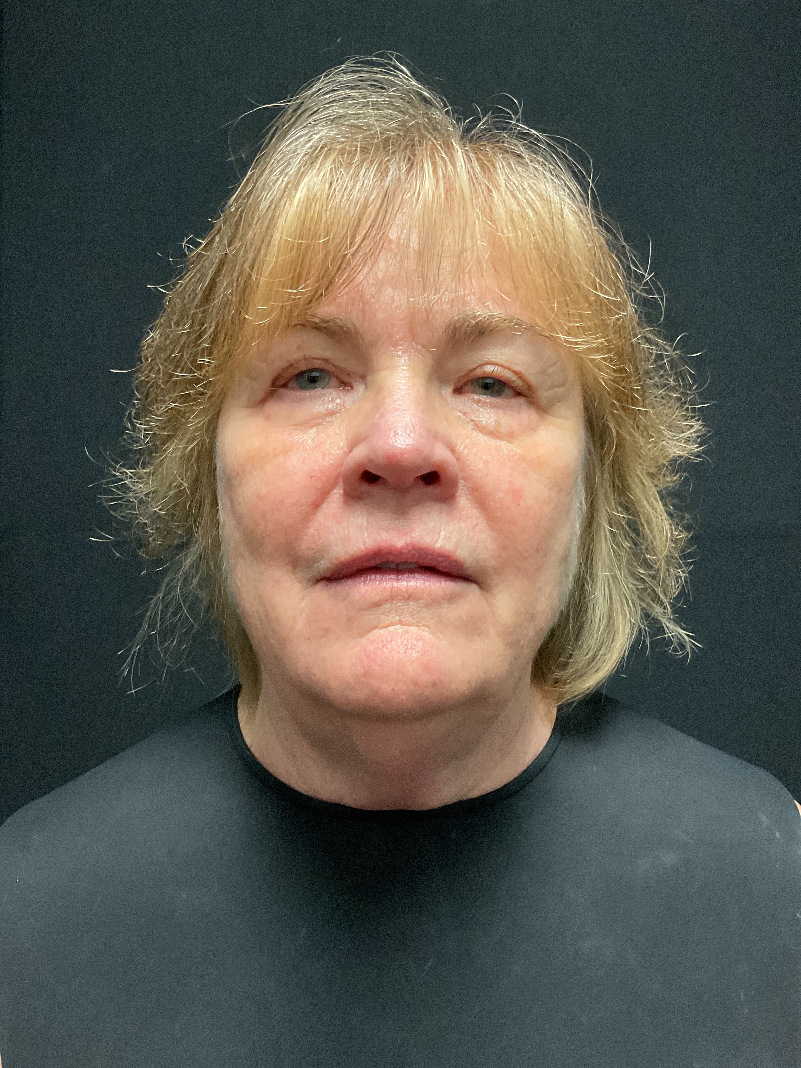 chin post 3 sessions-before