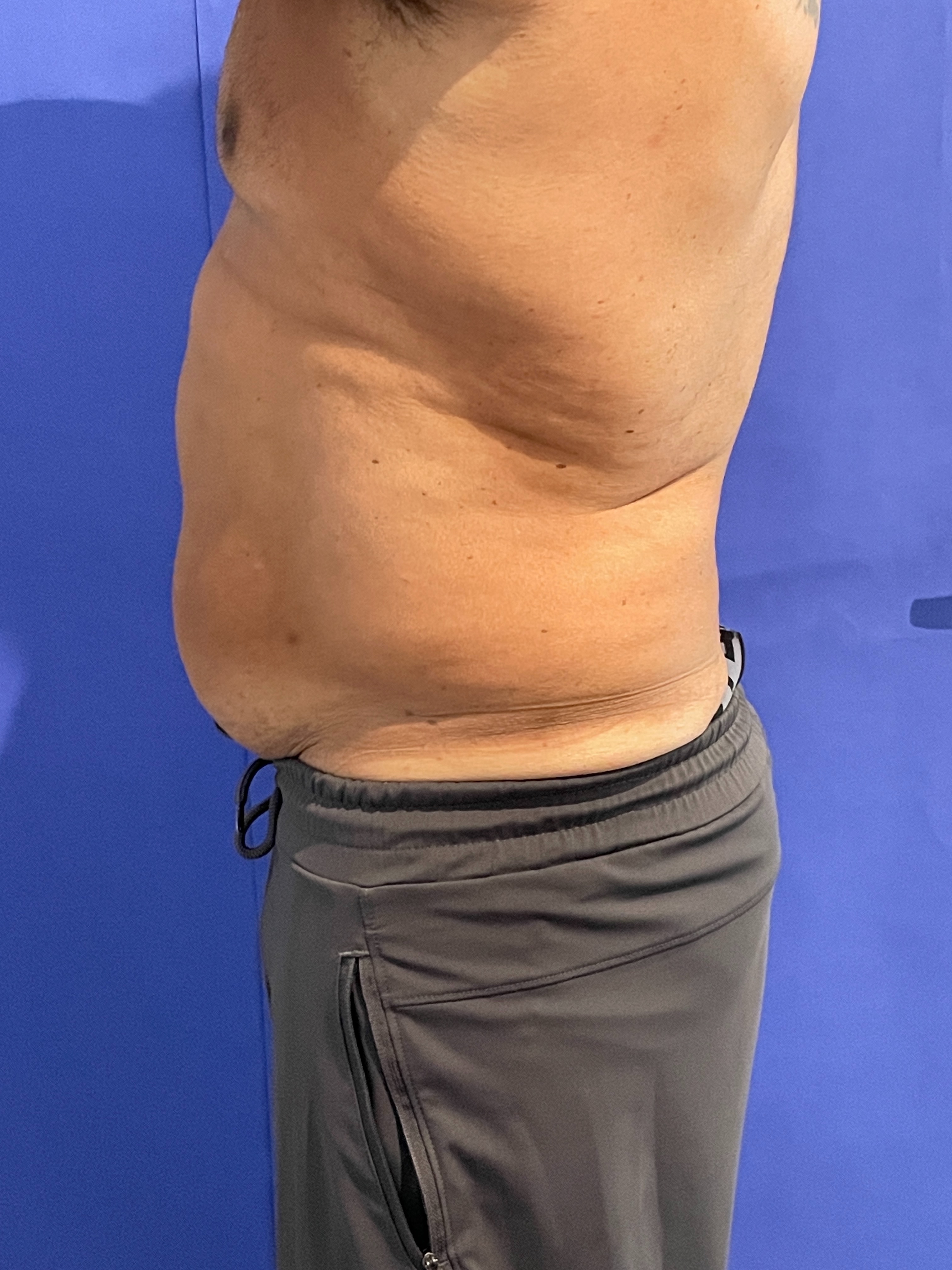 Belly lipo-before