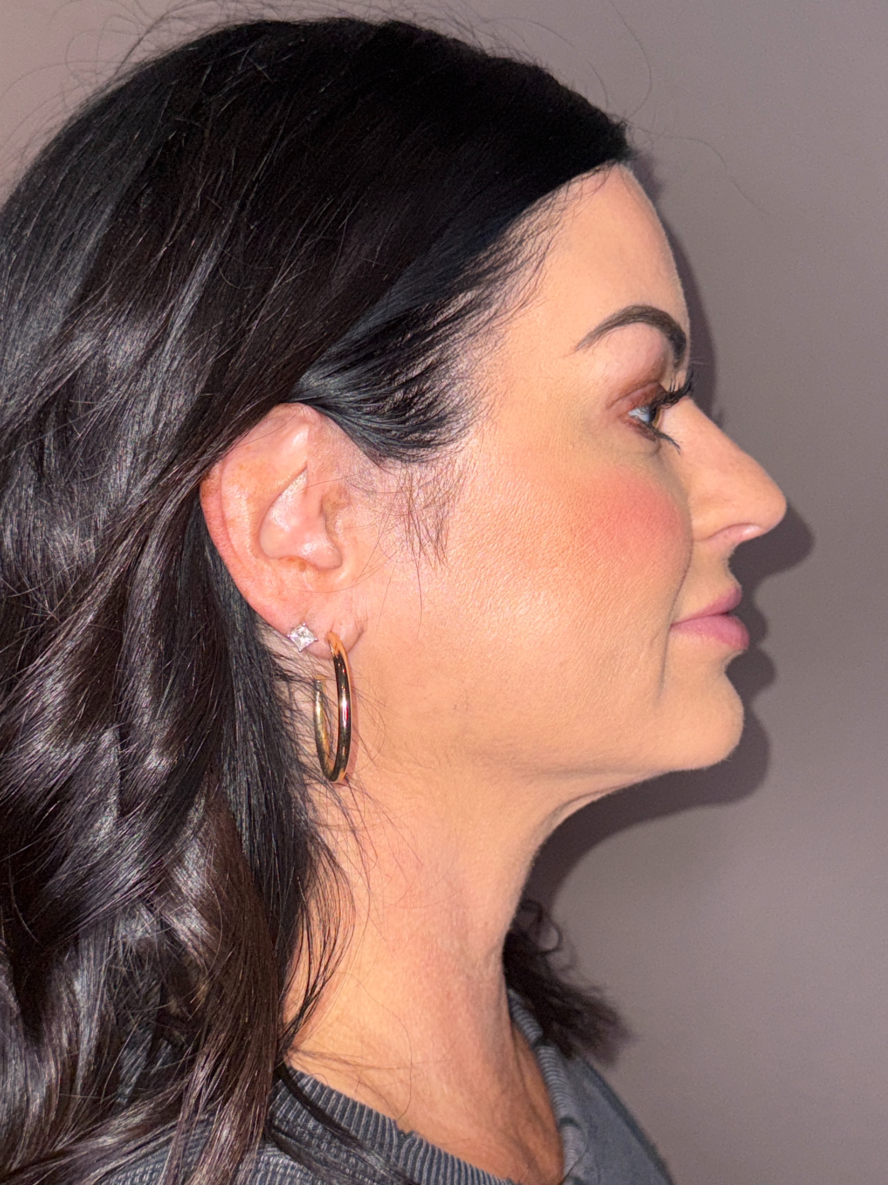 Emface- Submental (4)-after