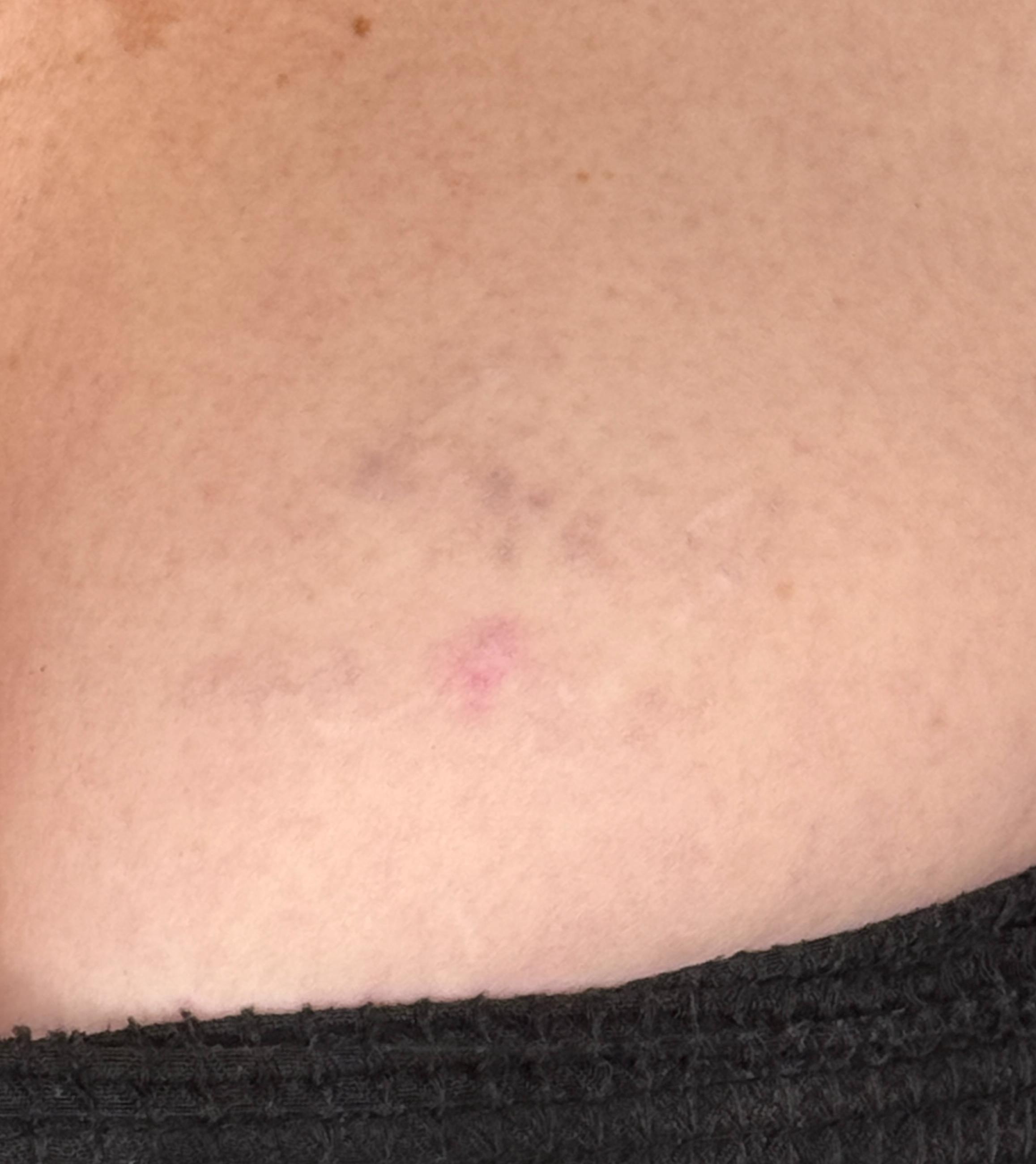 Ashley Reich RN: LTR-after