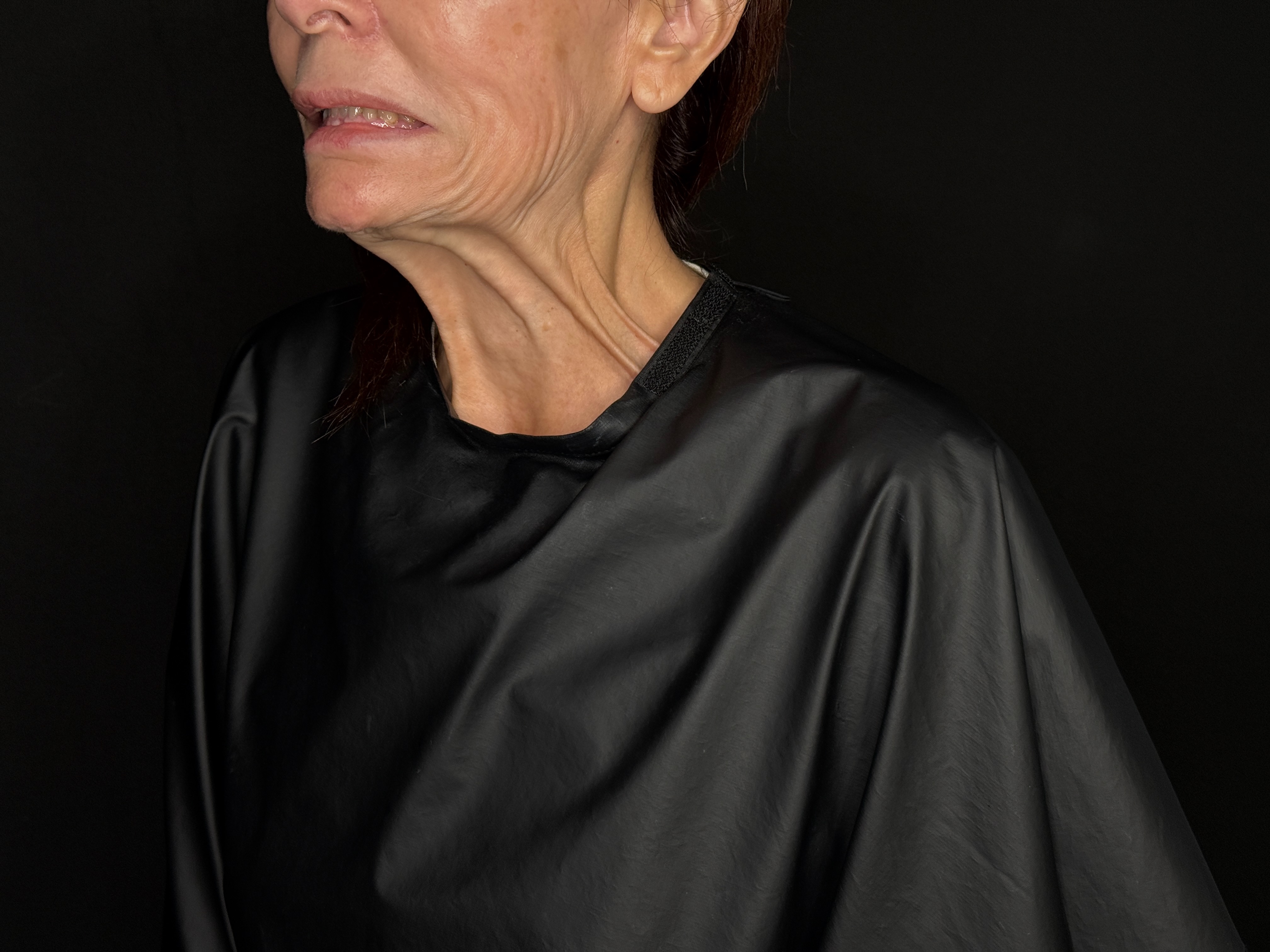 Ashley Reich RN: Platysmal Bands-before