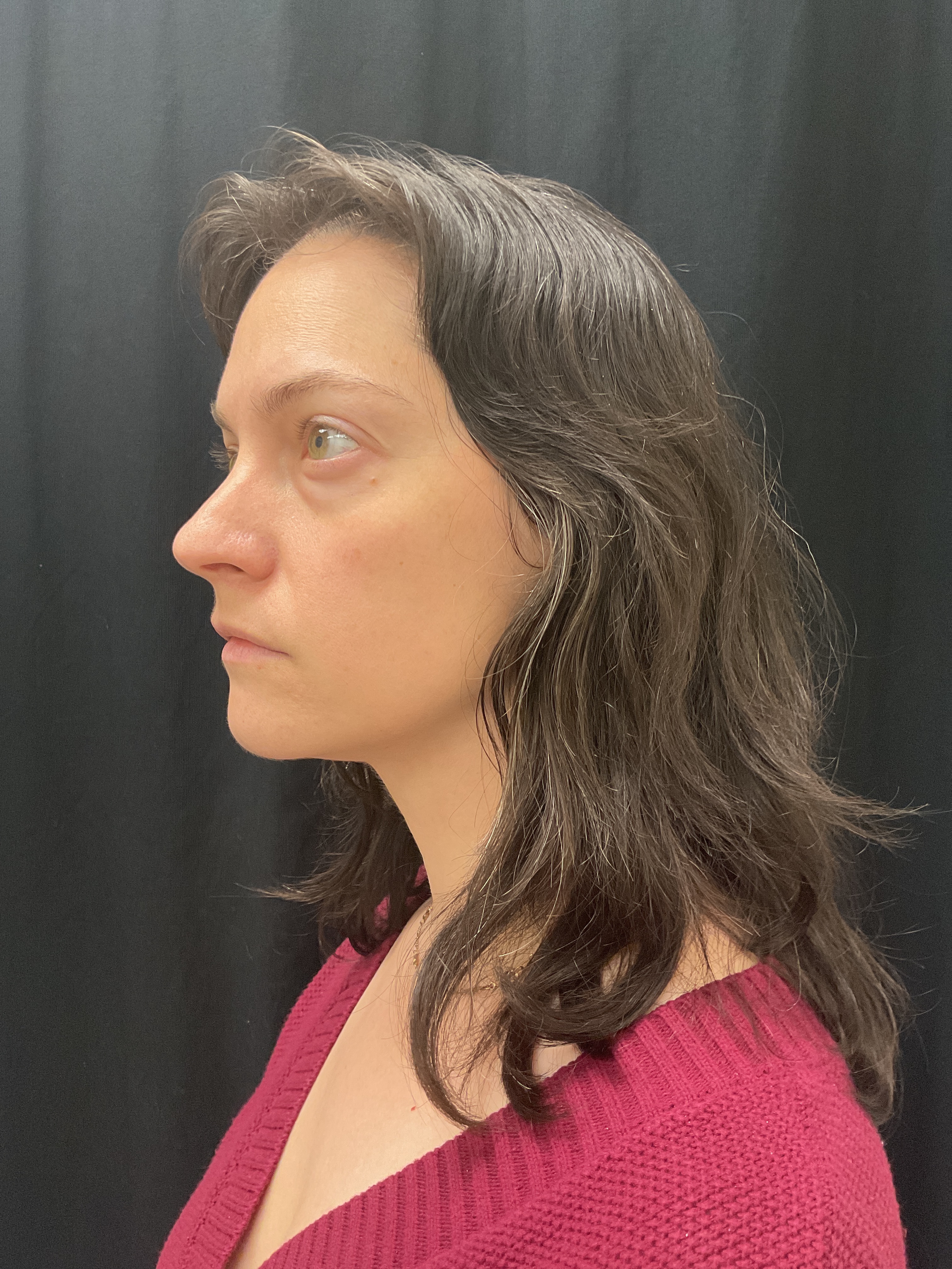 Botox / Dysport-before