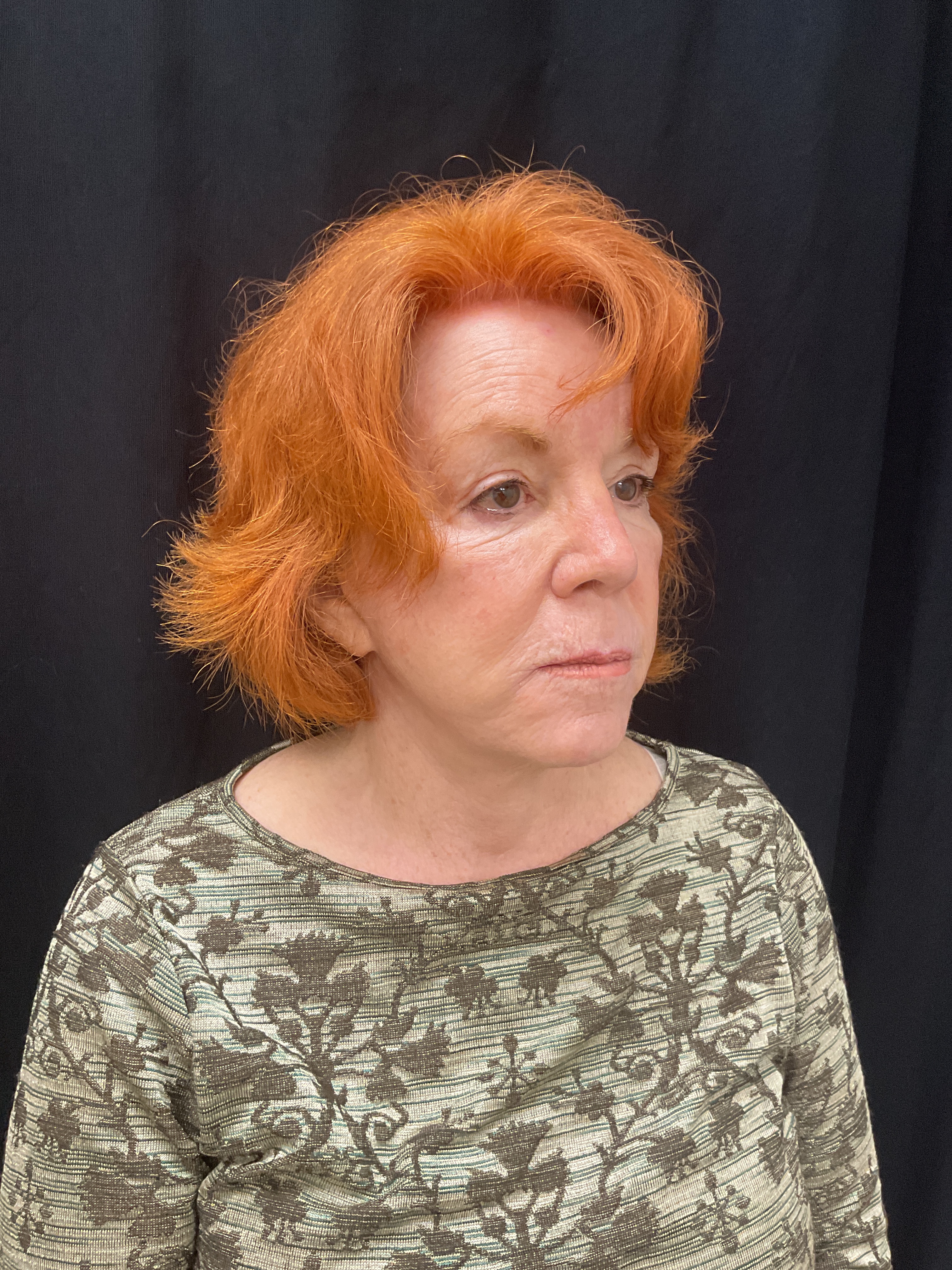 Linda Bertrum-before