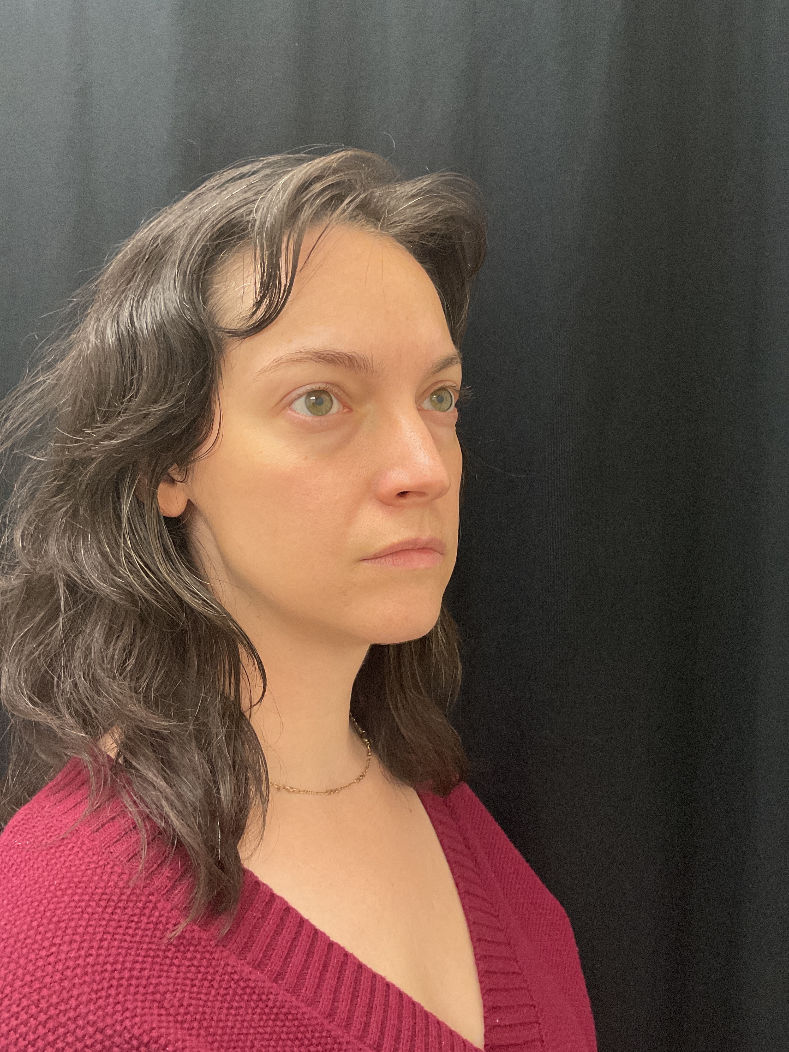 Botox / Dysport-after