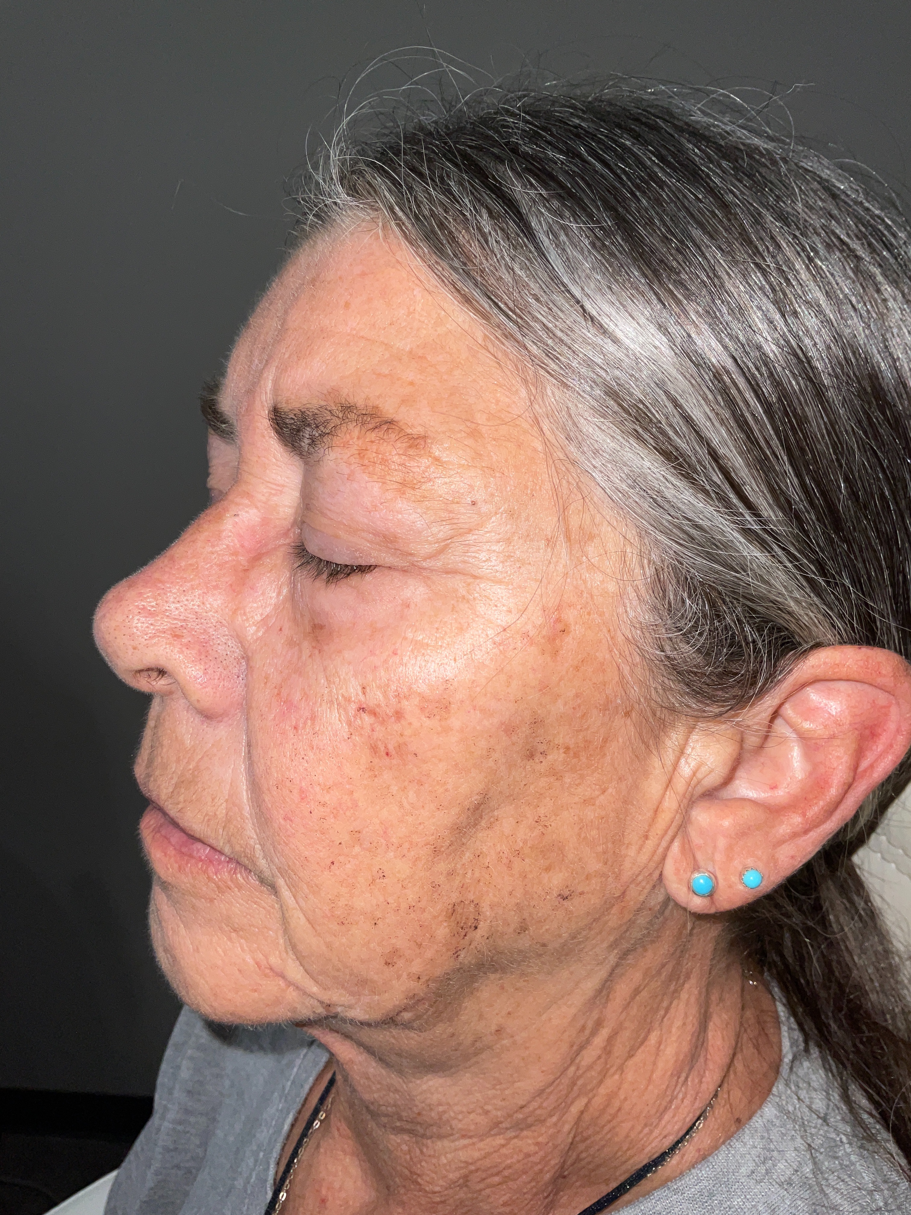 Age spots/dark spots-after