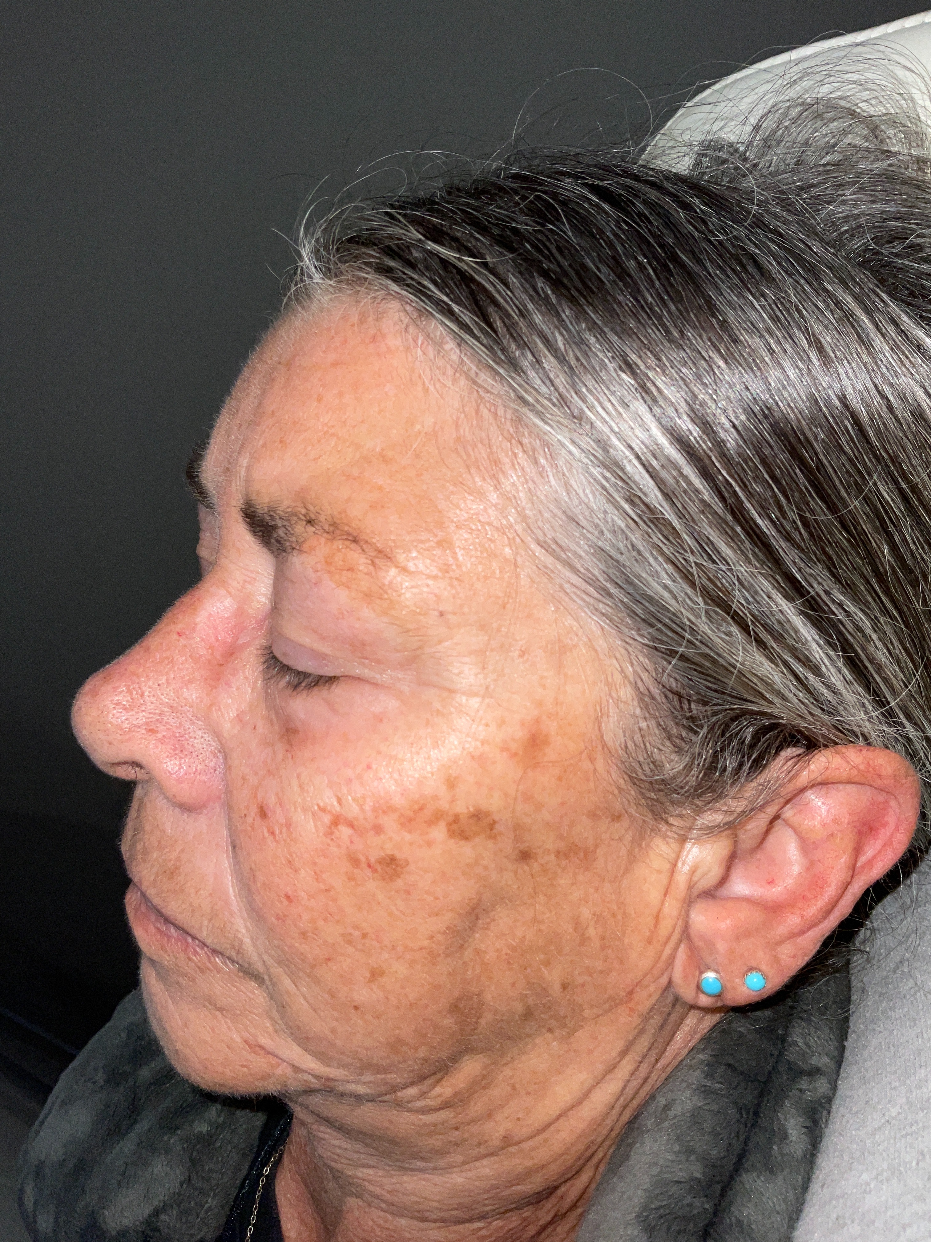 Age spots/dark spots-before