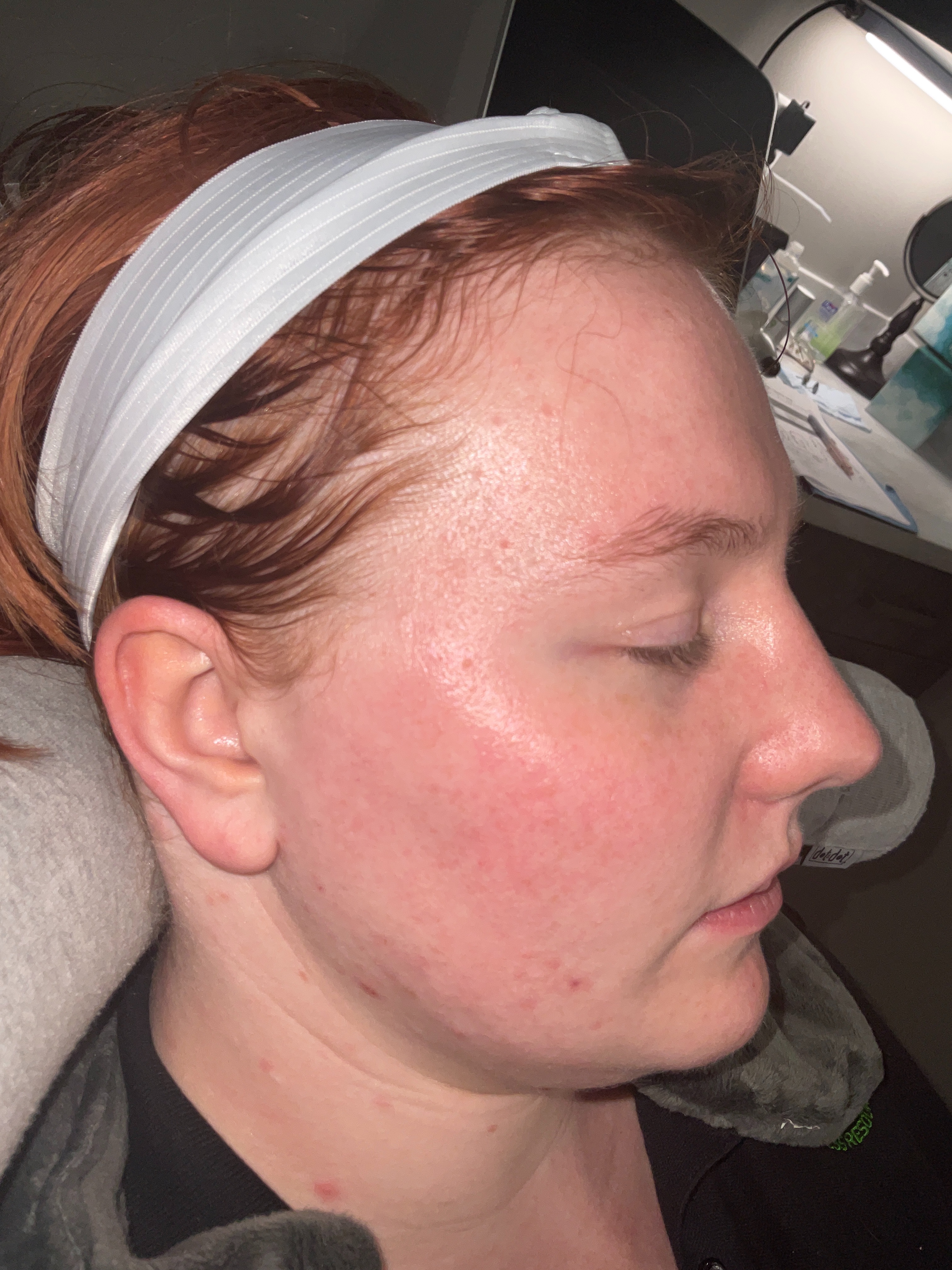 Rosacea/acne-before