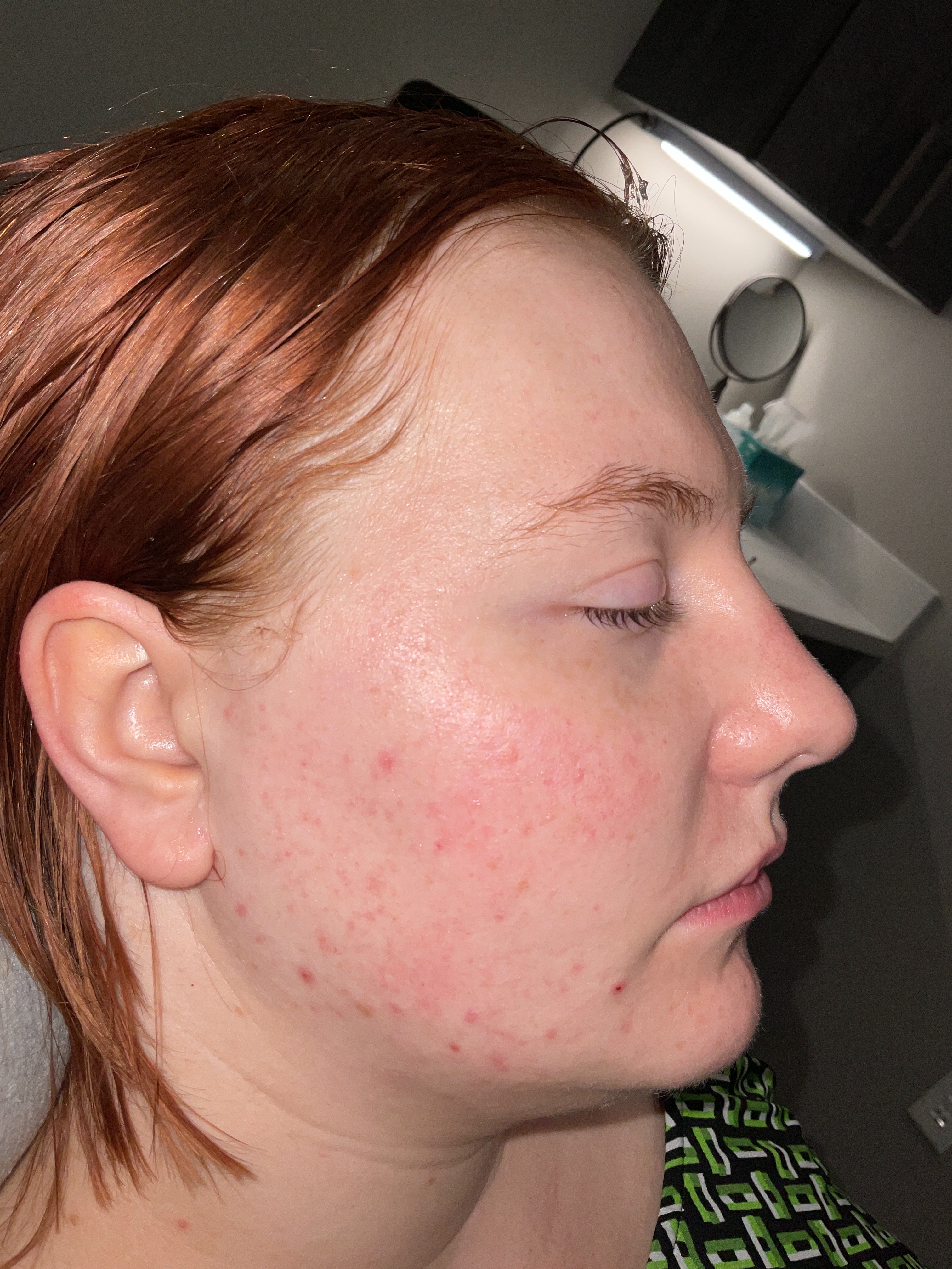 Rosacea/acne-after