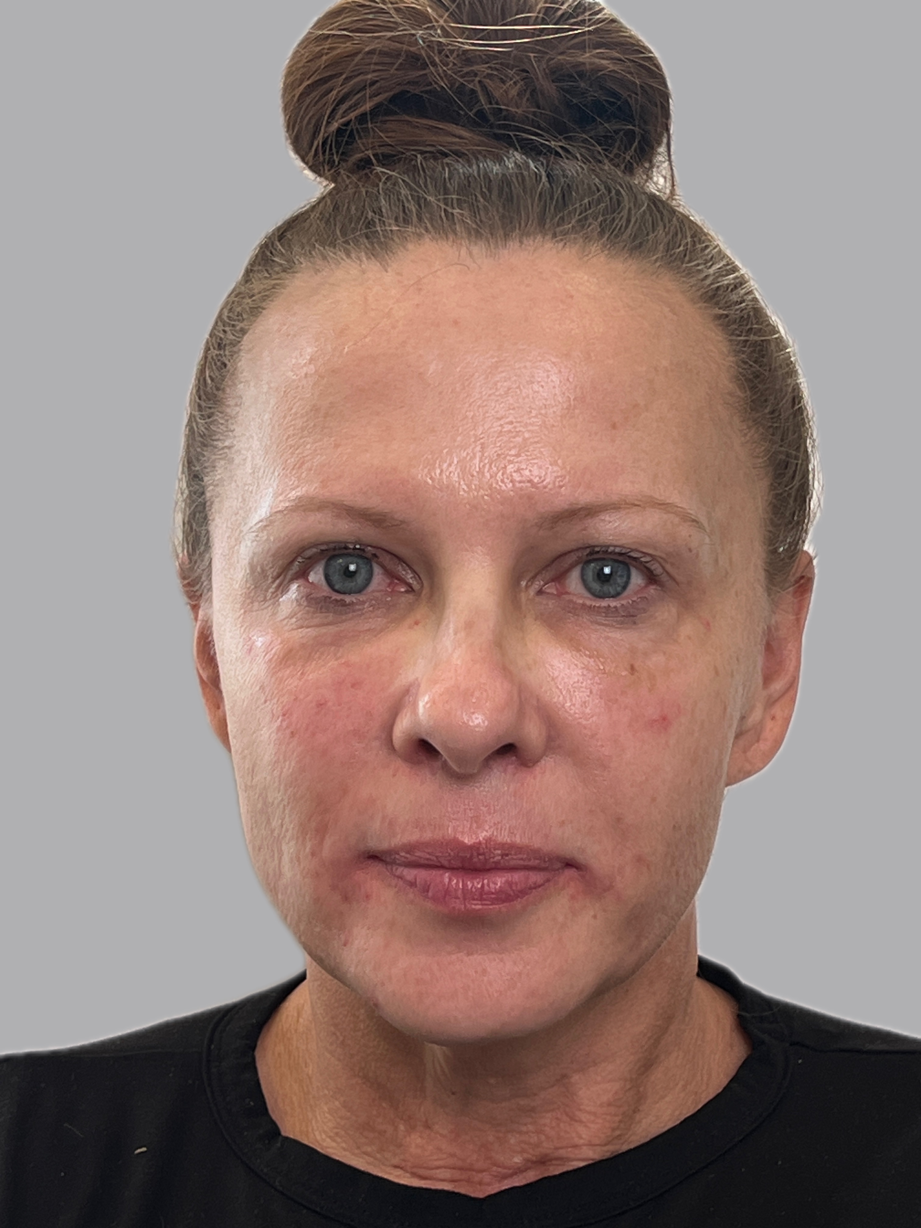 11 mL Cellenis Derma PRP: Under Eyes, Cheeks, Nasolabial Fold-after