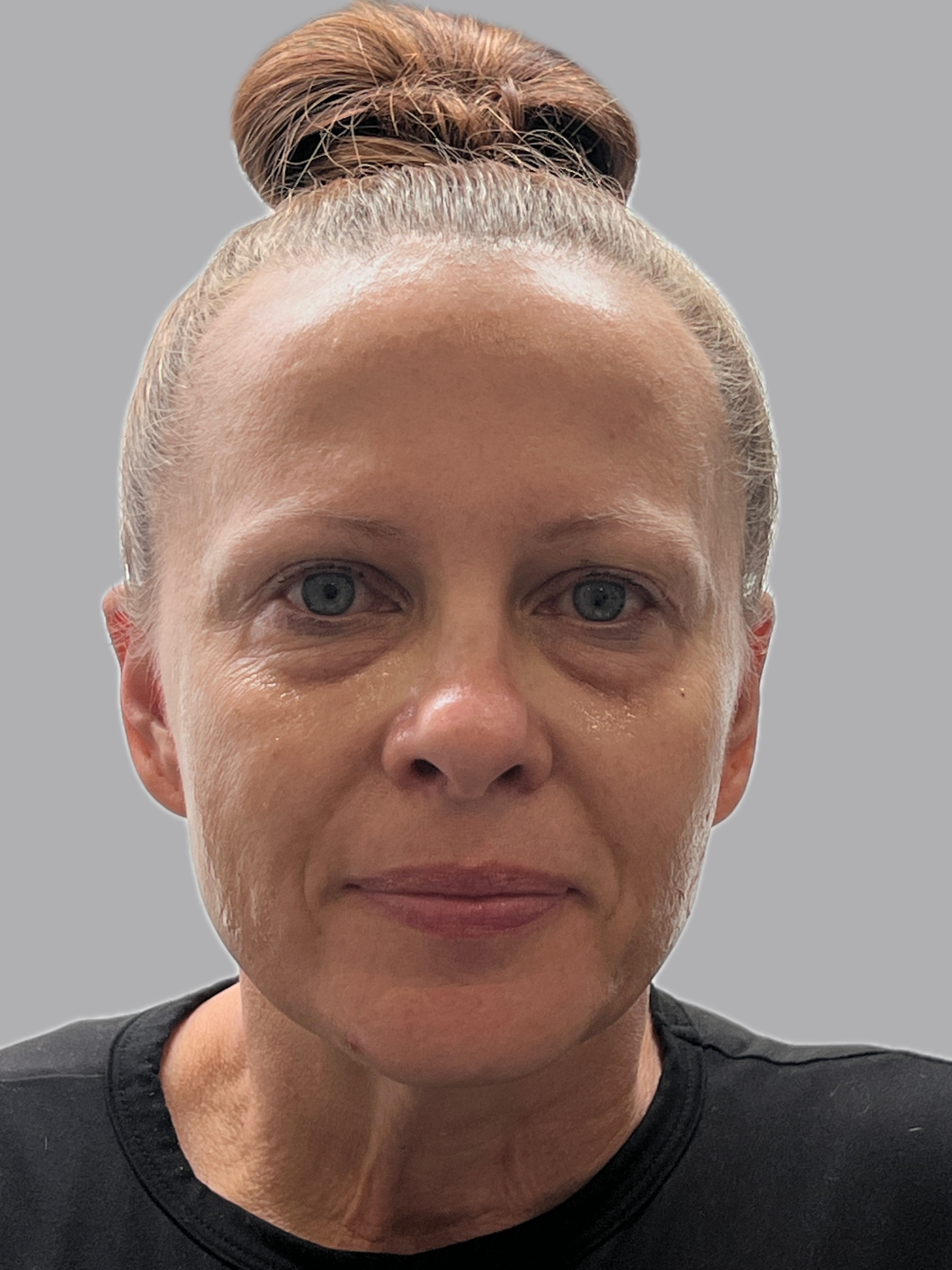 11 mL Cellenis Derma PRP: Under Eyes, Cheeks, Nasolabial Fold-before