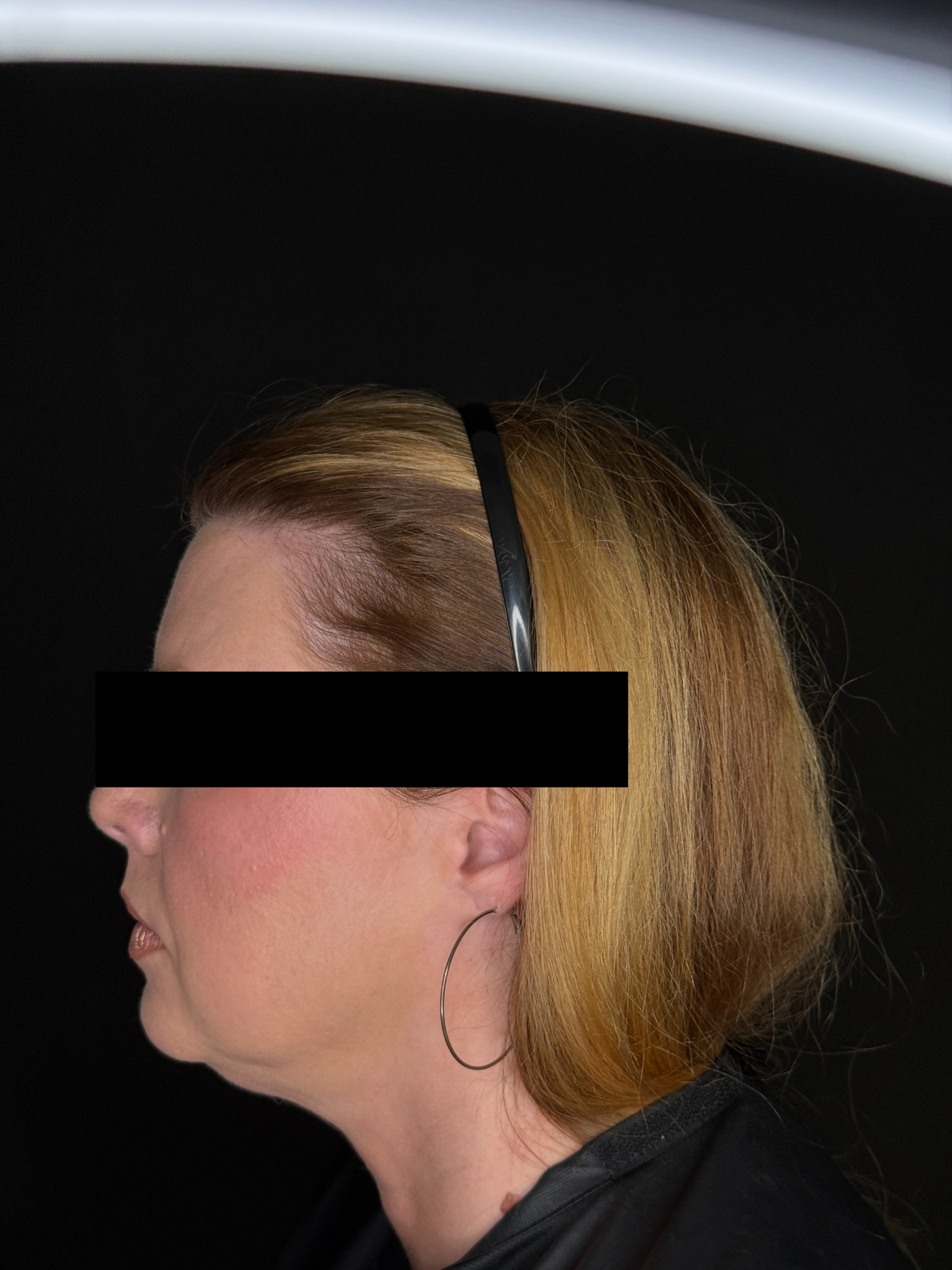Sharon McKenny LME, Exilis Lower Face & Chin Strap-after