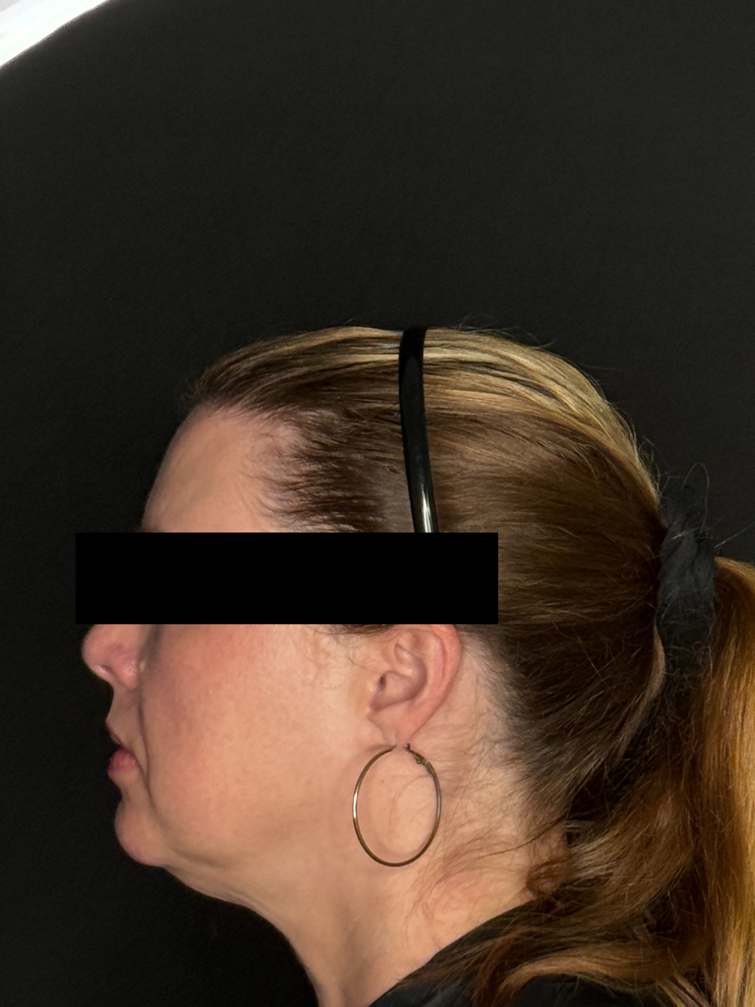 Sharon McKenny LME, Exilis Lower Face & Chin Strap-before
