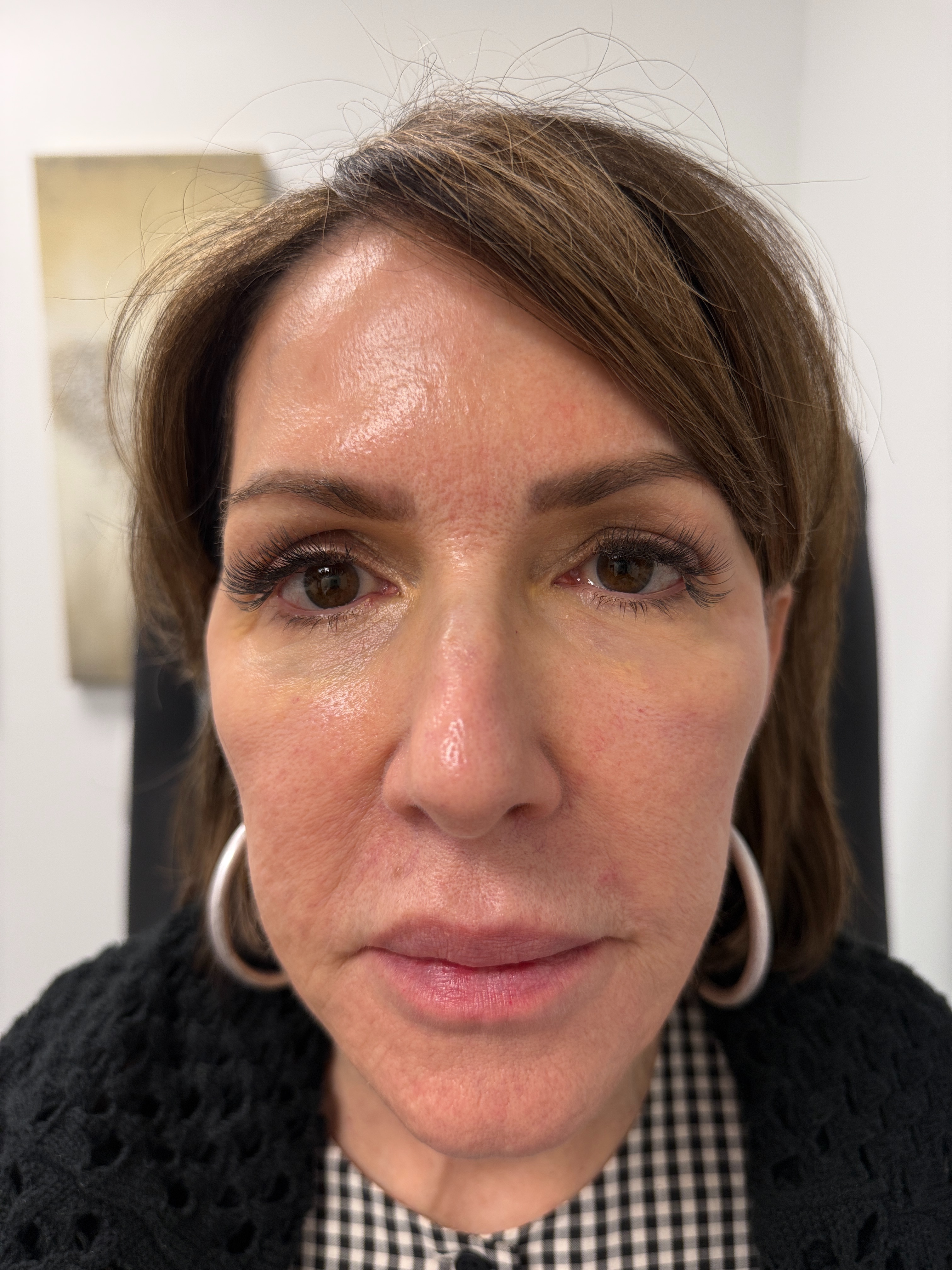 after 2 laser genesis-before