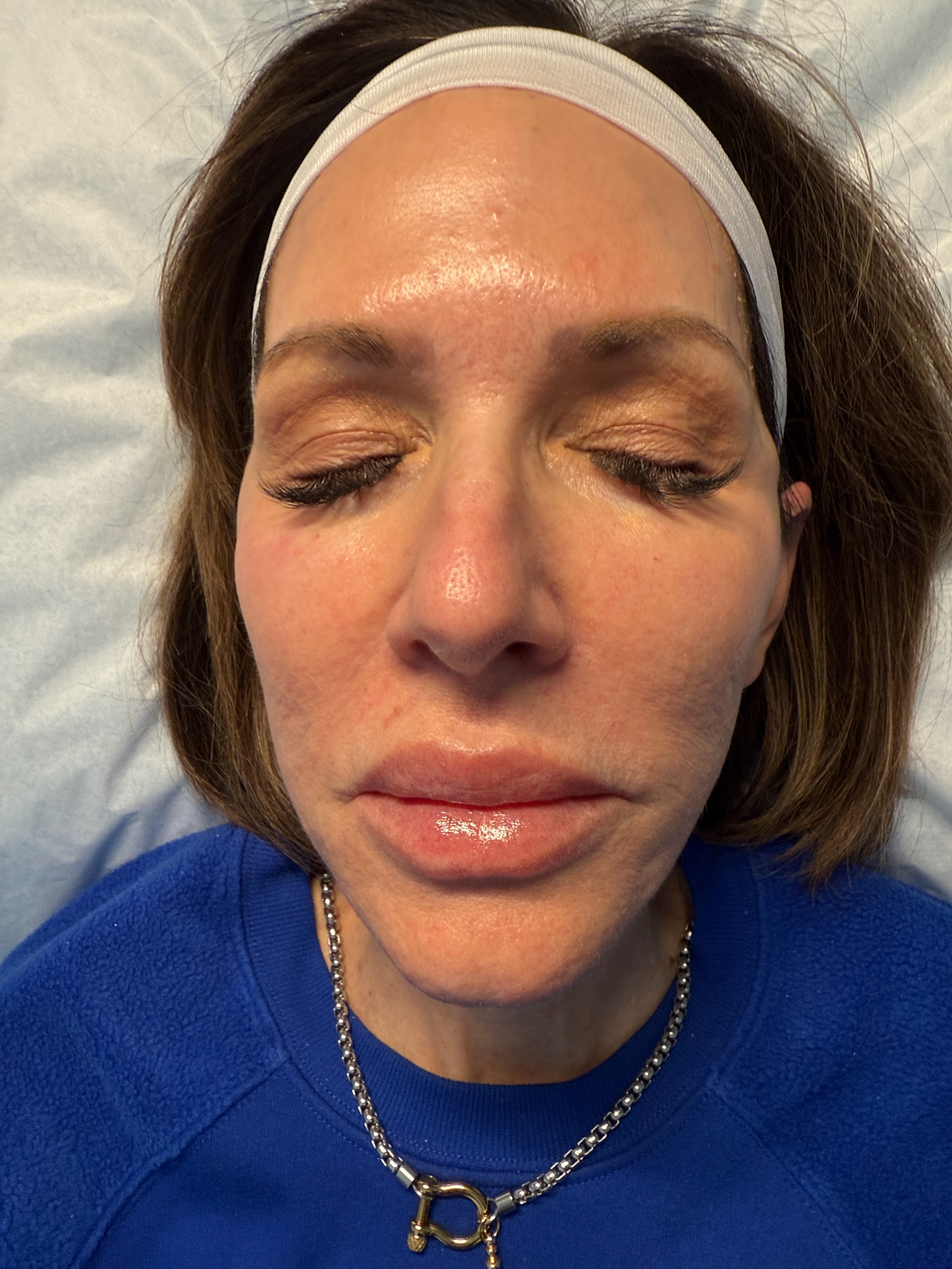 after 2 laser genesis-after