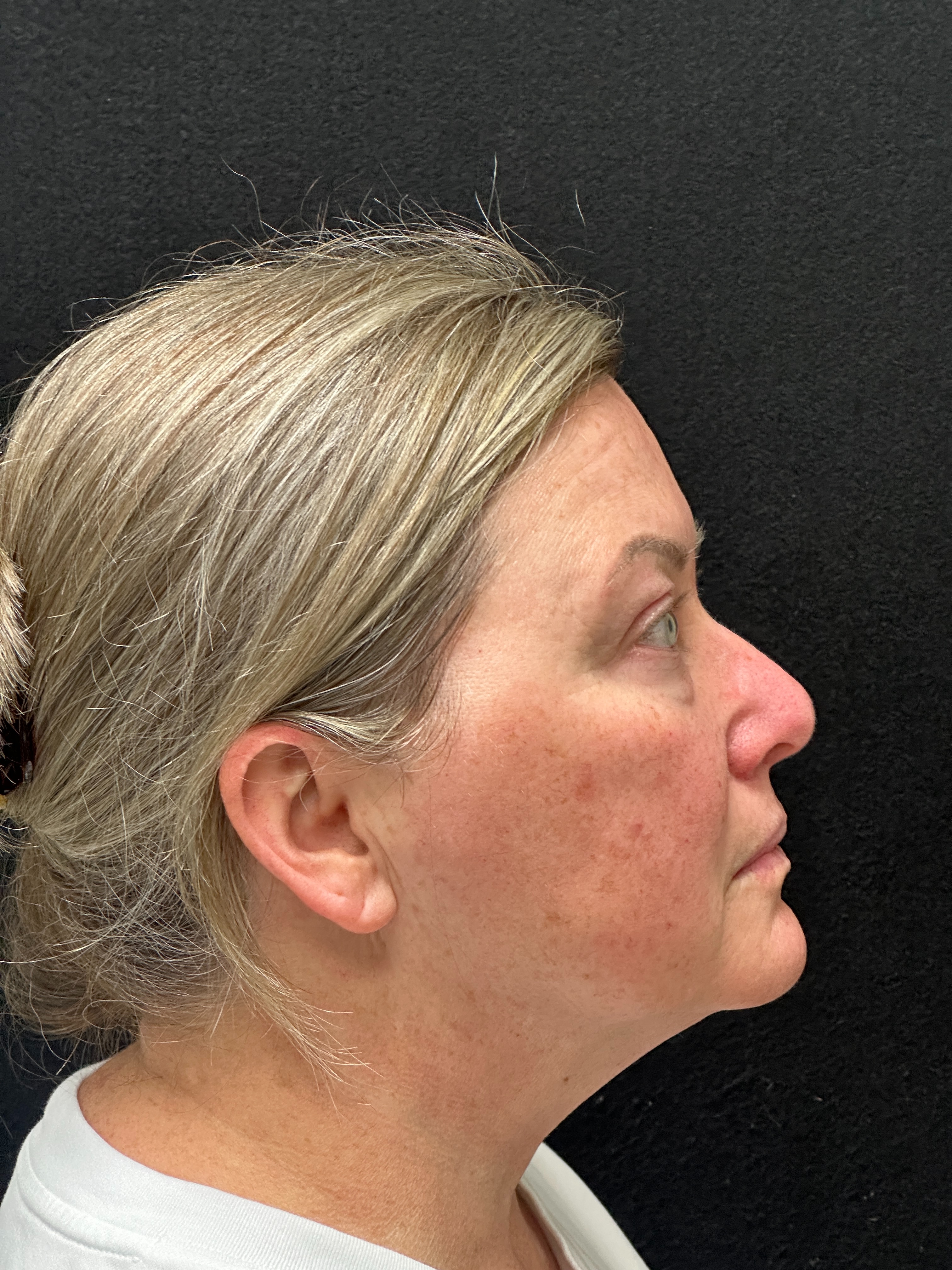 Lumecca x3, then Fraxel and Morpheus-before