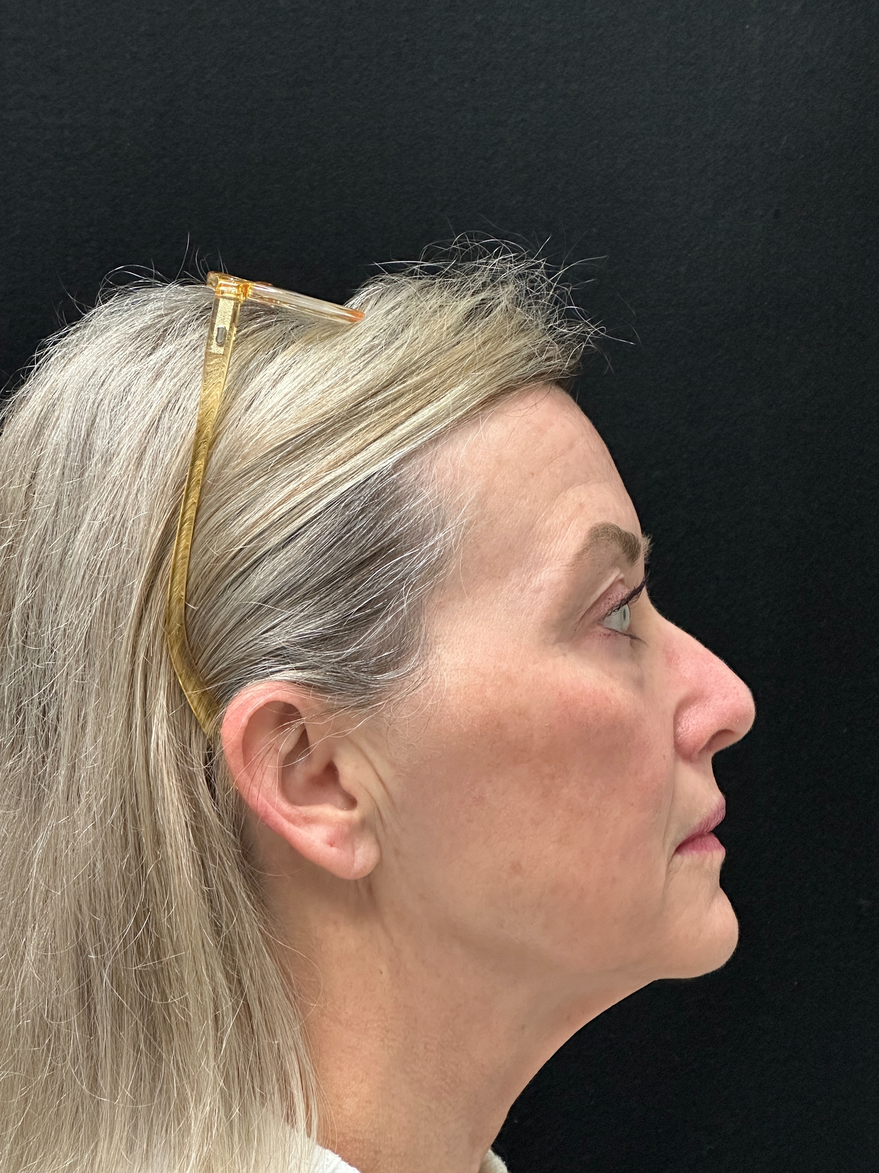 Lumecca x3, then Fraxel and Morpheus-after