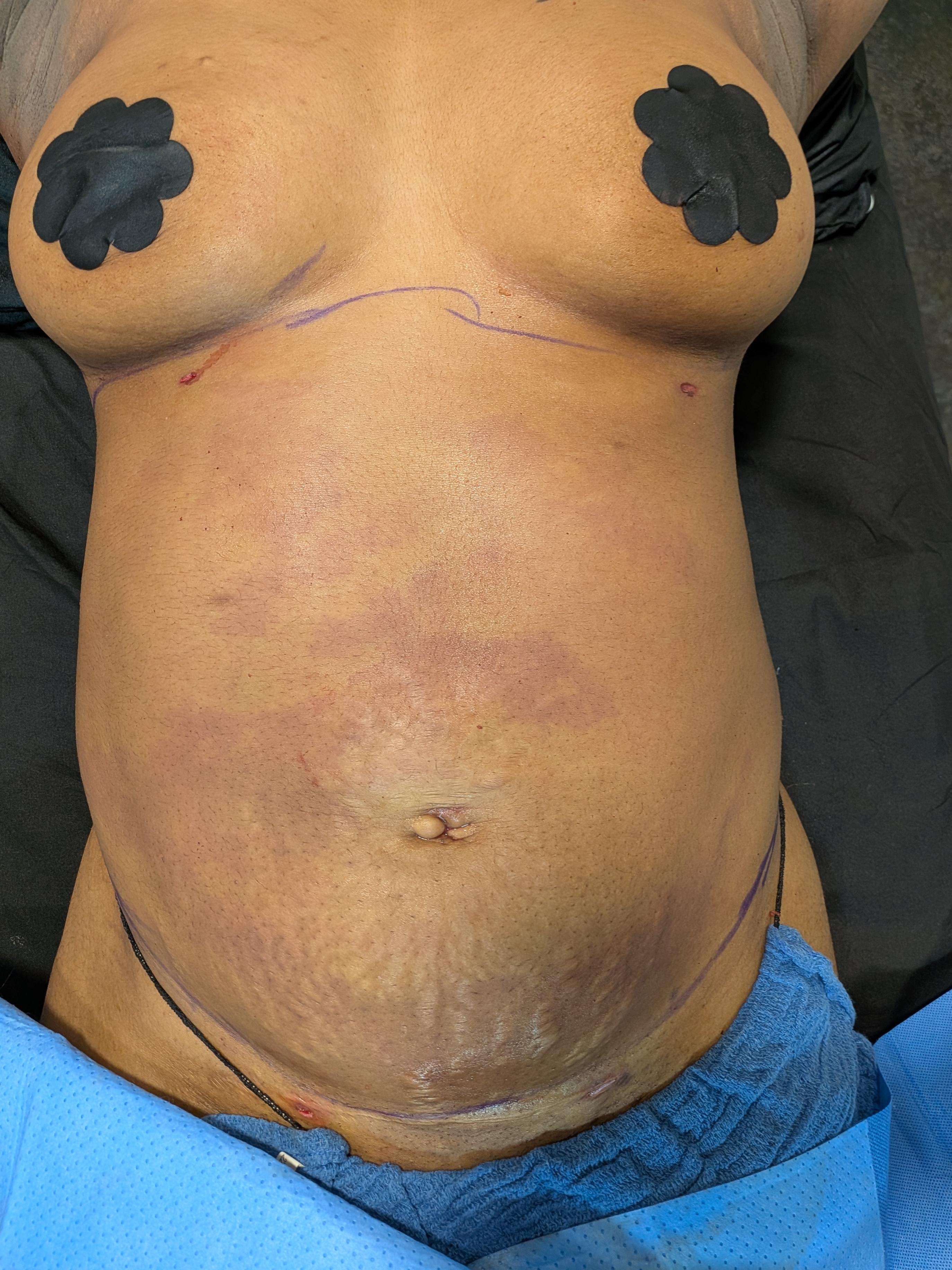 Sykes abdomen fat transfer to breast-after