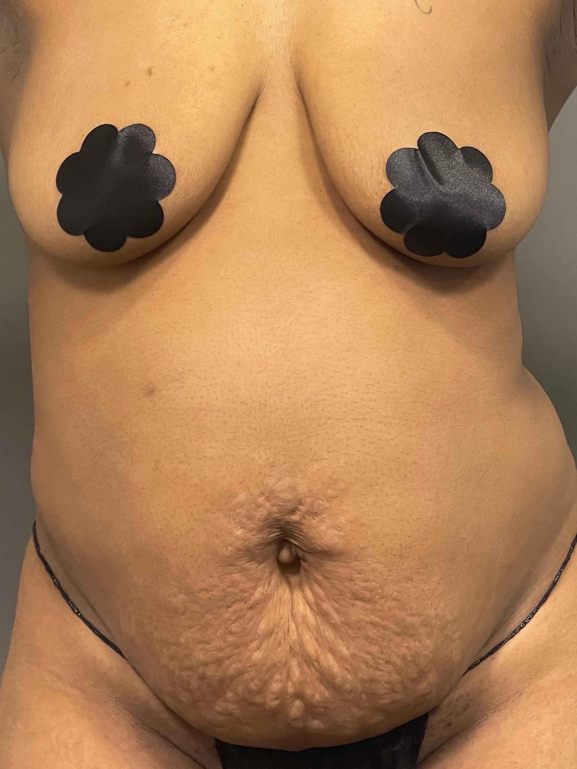 Sykes abdomen fat transfer to breast-before