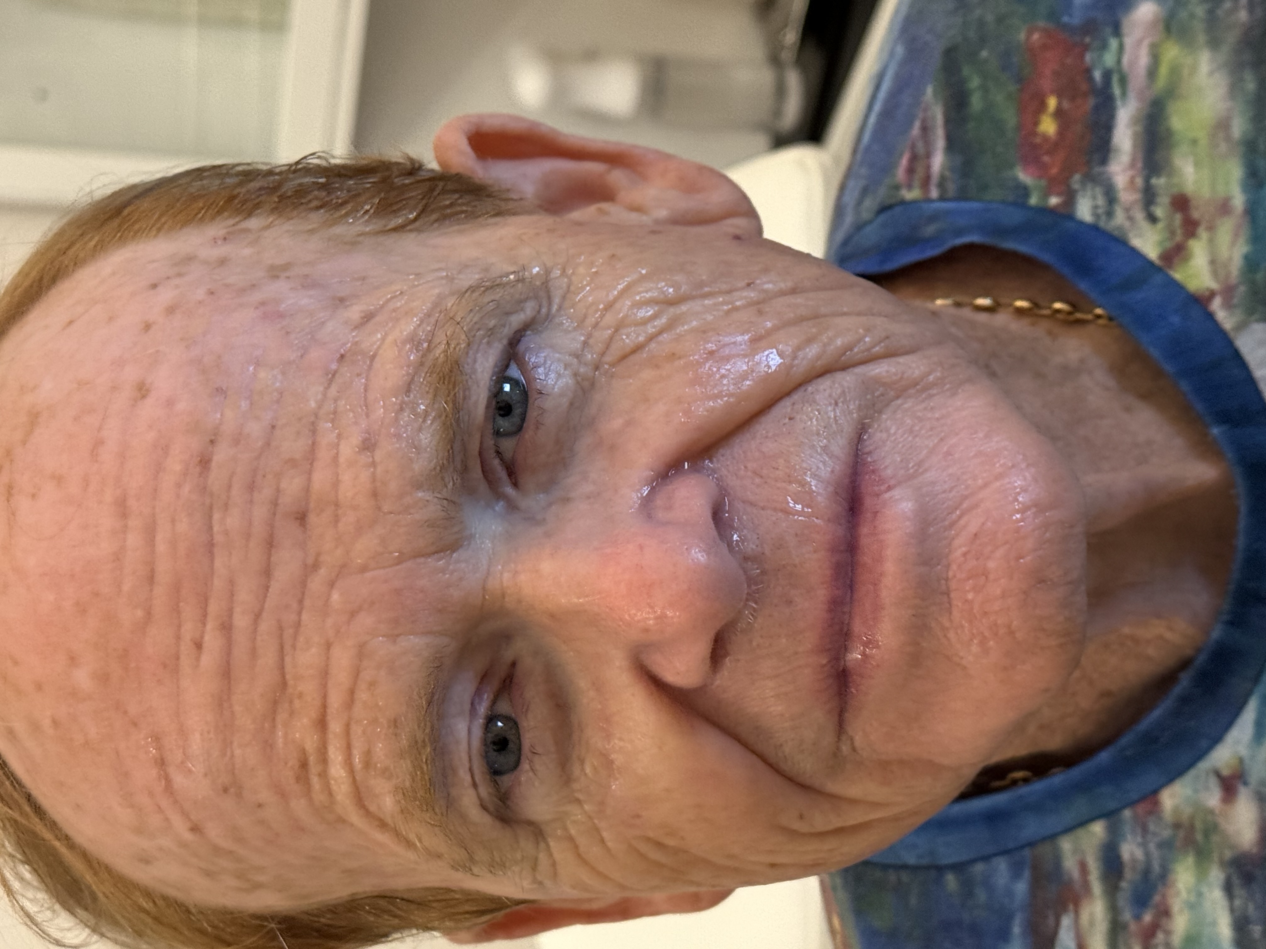 After Only One Treatment of TriLift-before