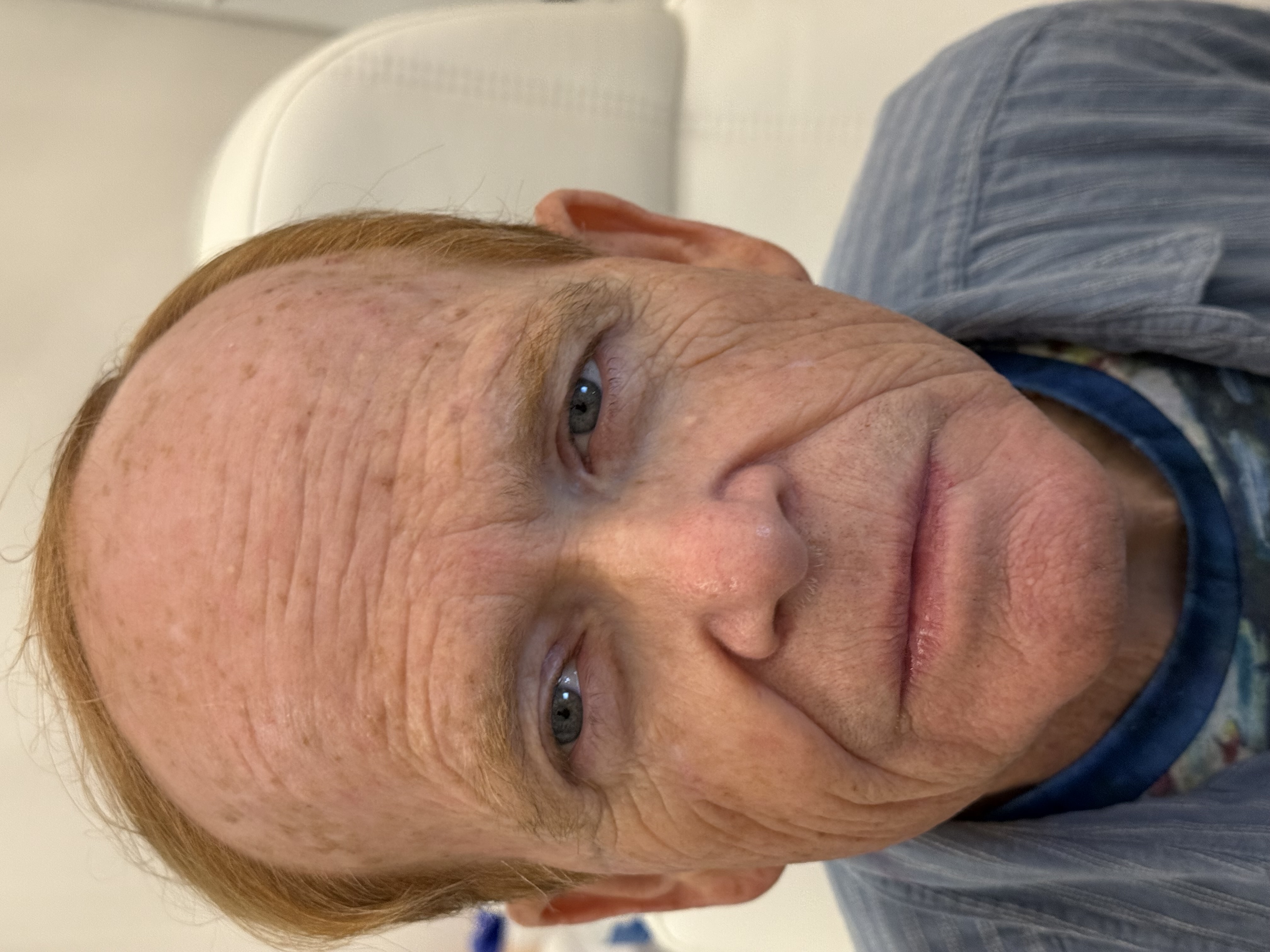 Dr Roberts after a few session of Dry Eye, IPL, ResurFX, & TriLift-before