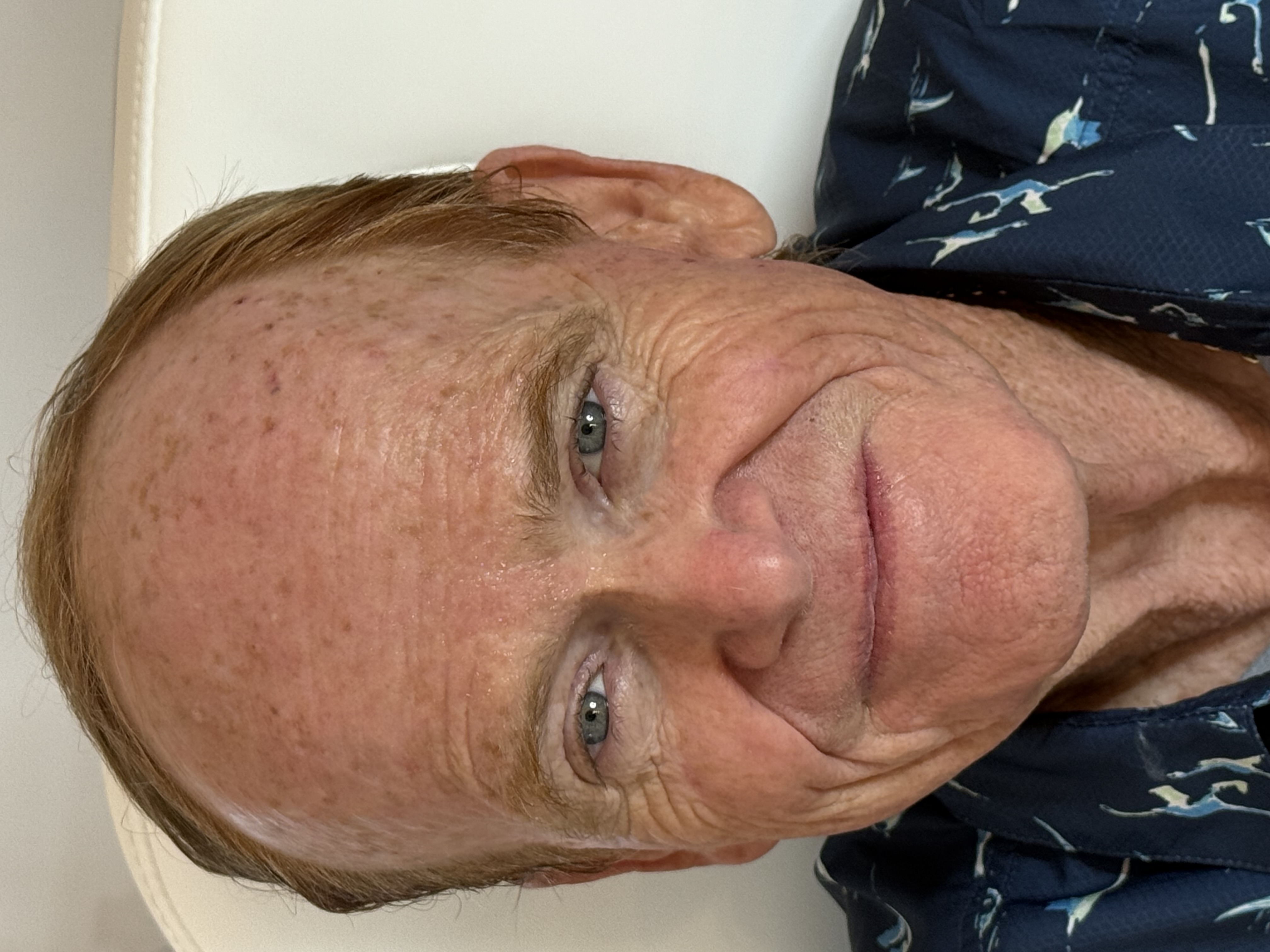 After Only One Treatment of TriLift-after