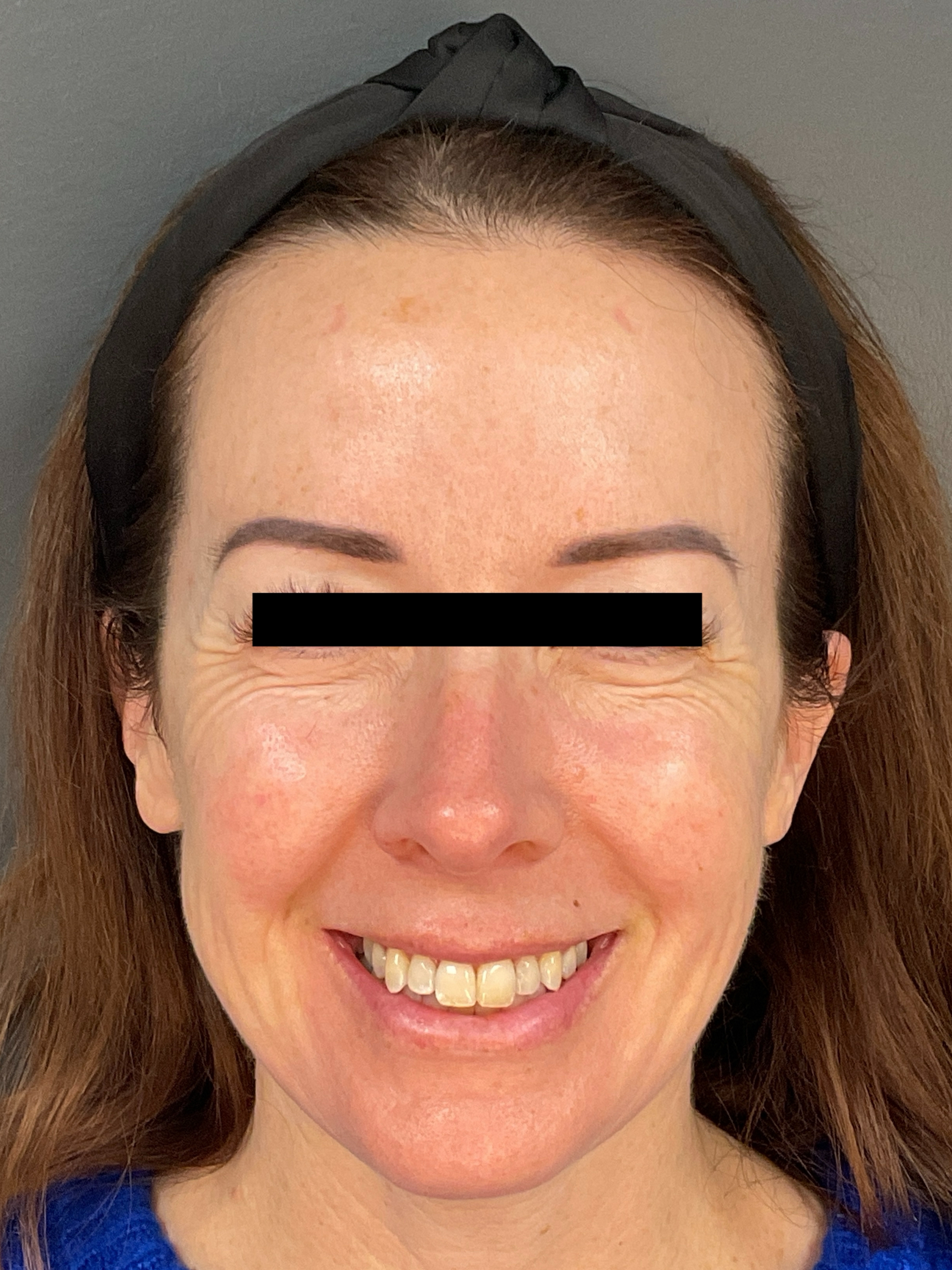 Contour: Smiling-before