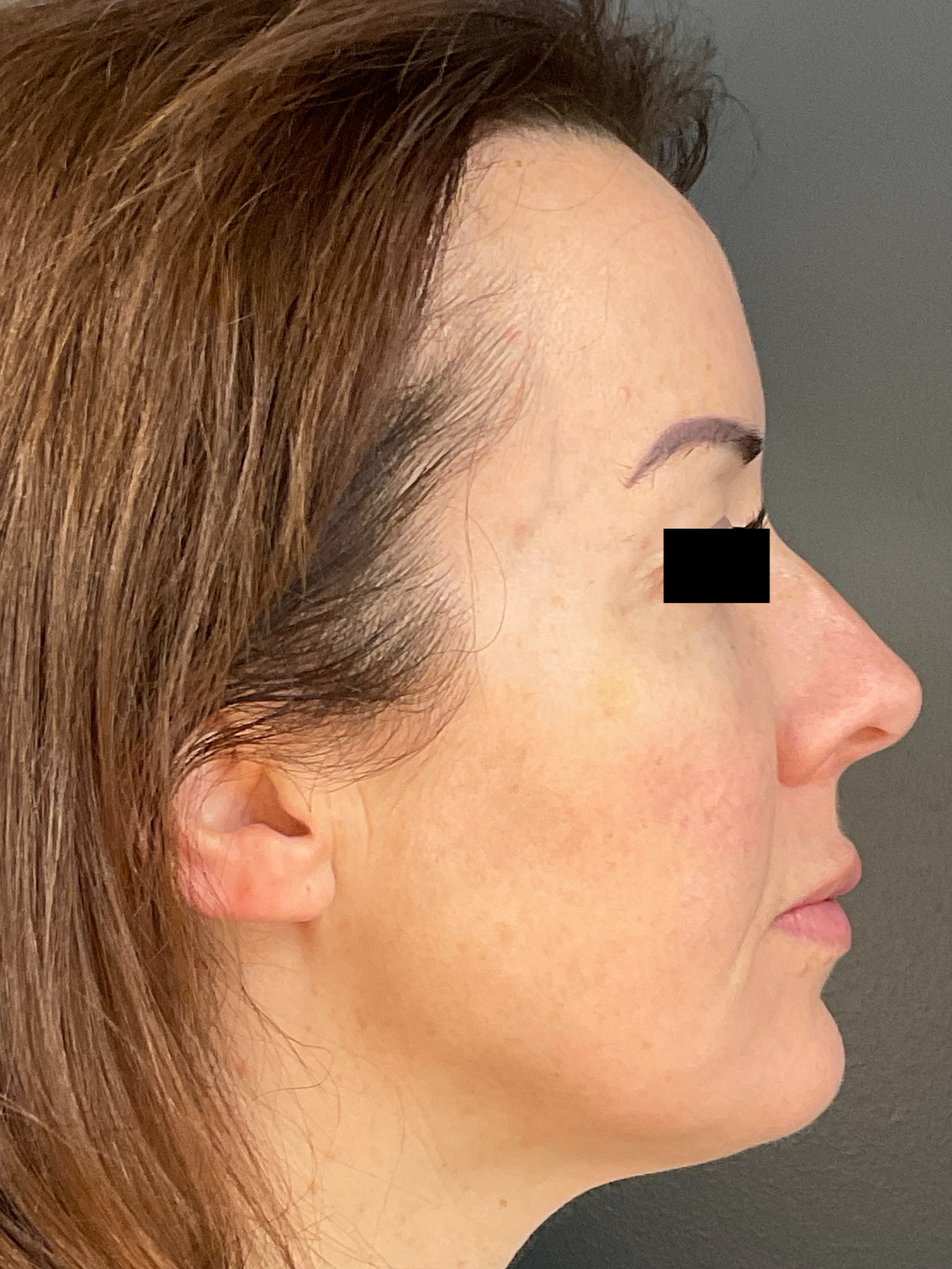 Contour: Right Profile-after