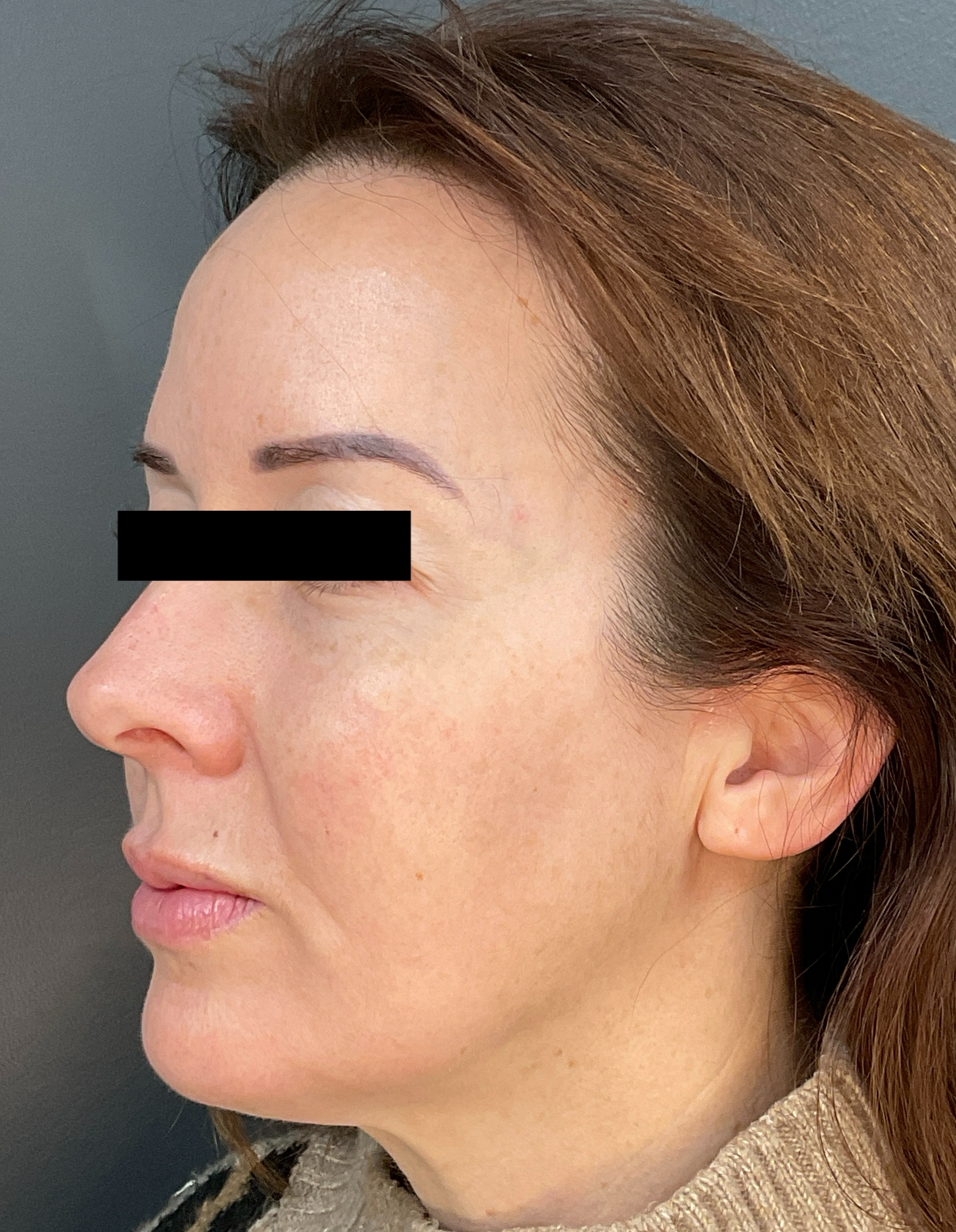 Contour: Left Angle-after