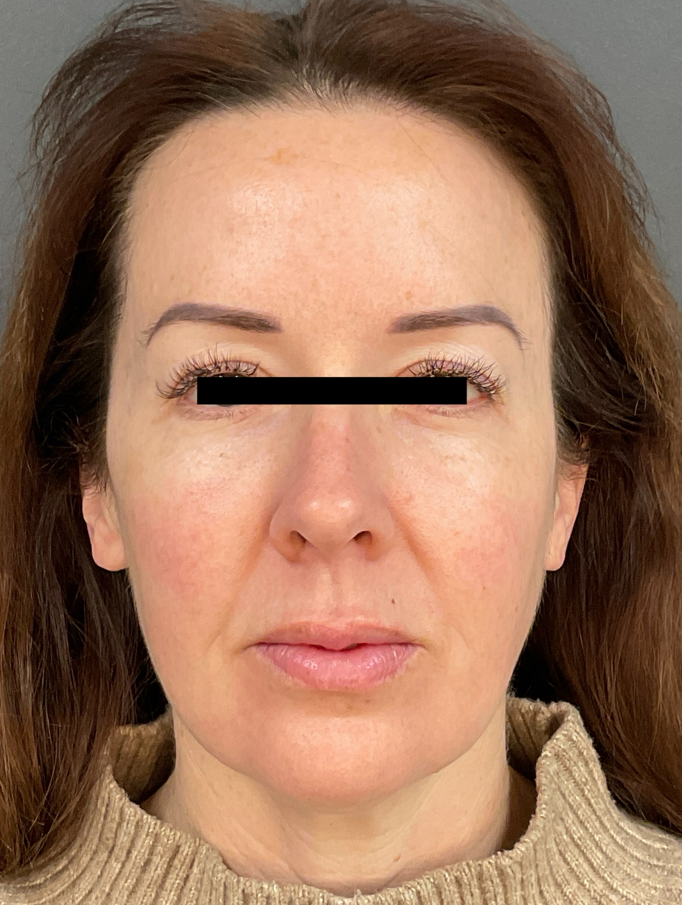 Contour: Front-after