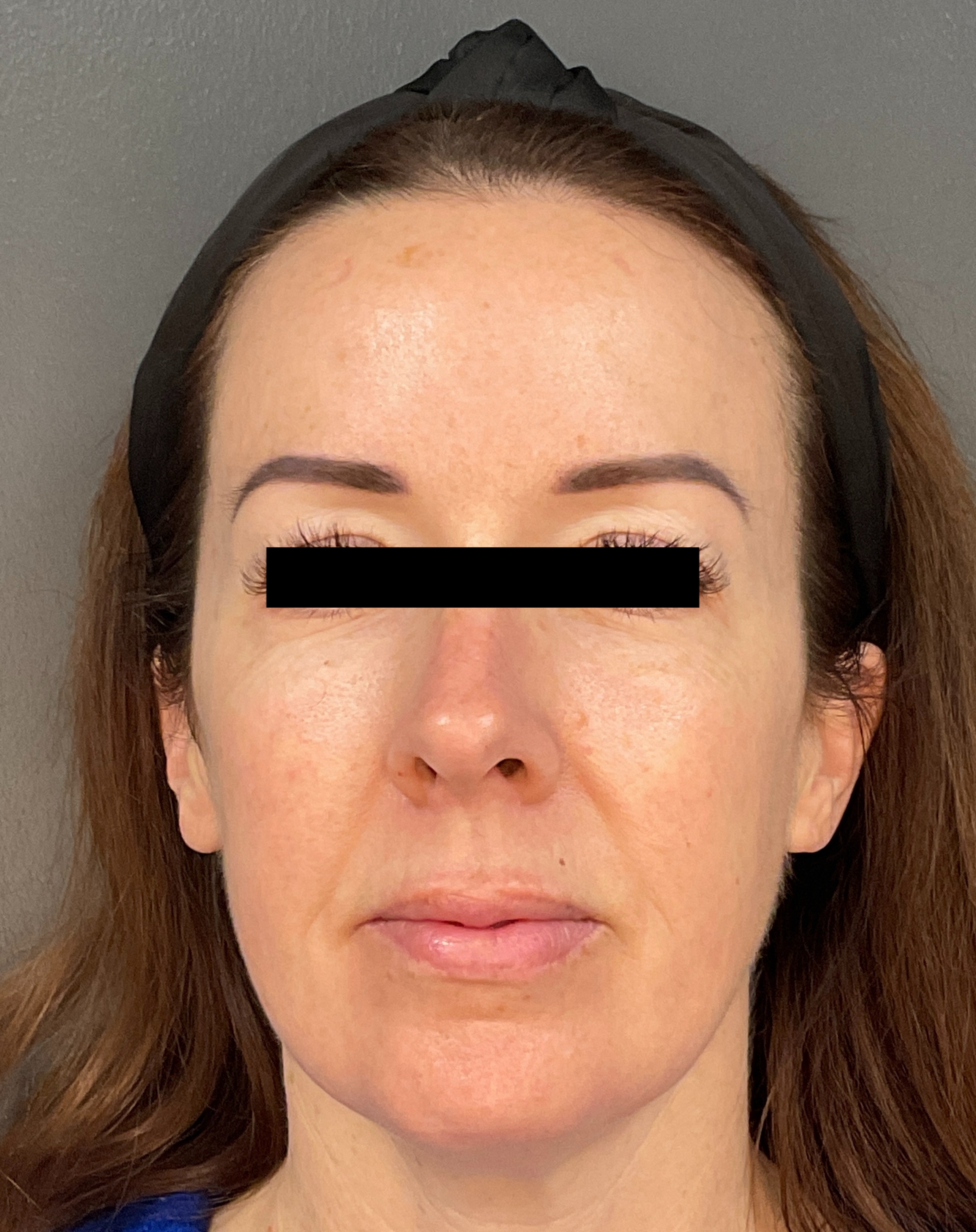 Contour: Front-before